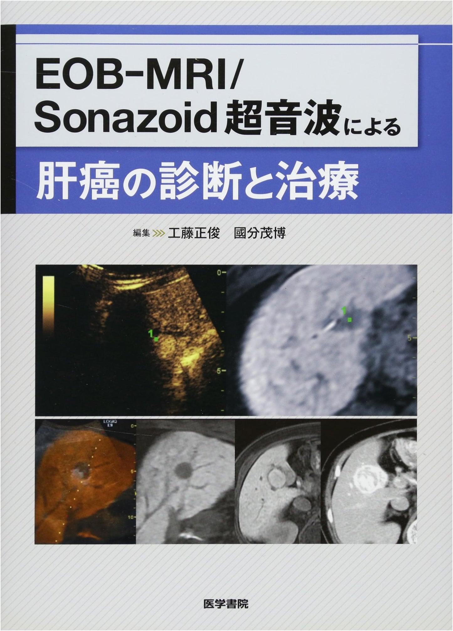 EOB-MRI/Sonazoid Ultrasound for Diagnosis & Treatment of Liver Cancer