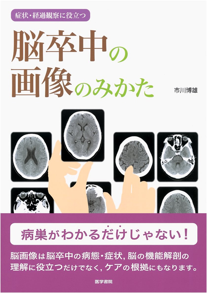 Understanding Stroke Imaging: A Guide to Symptoms & Prognosis