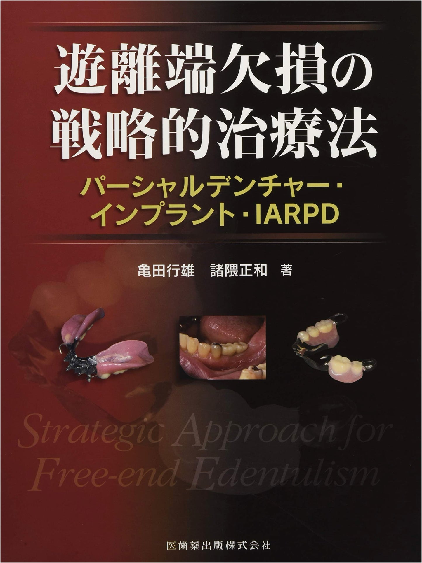 Strategic Treatment for Free-End Edentulism: Partial Dentures, Implants, and IARPD