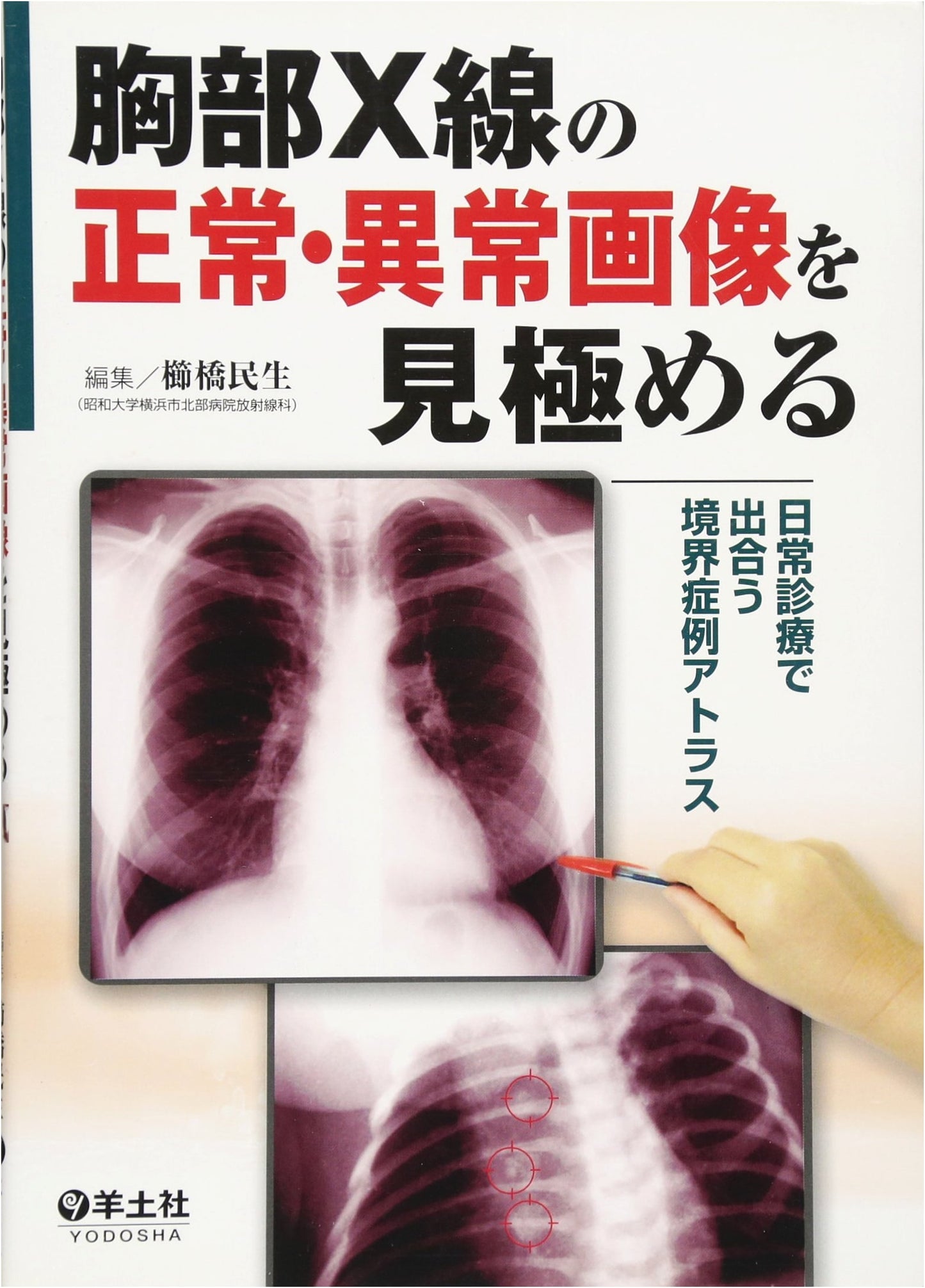 Atlas of Borderline Chest X-Ray Cases: Differentiating Normal & Abnormal Images