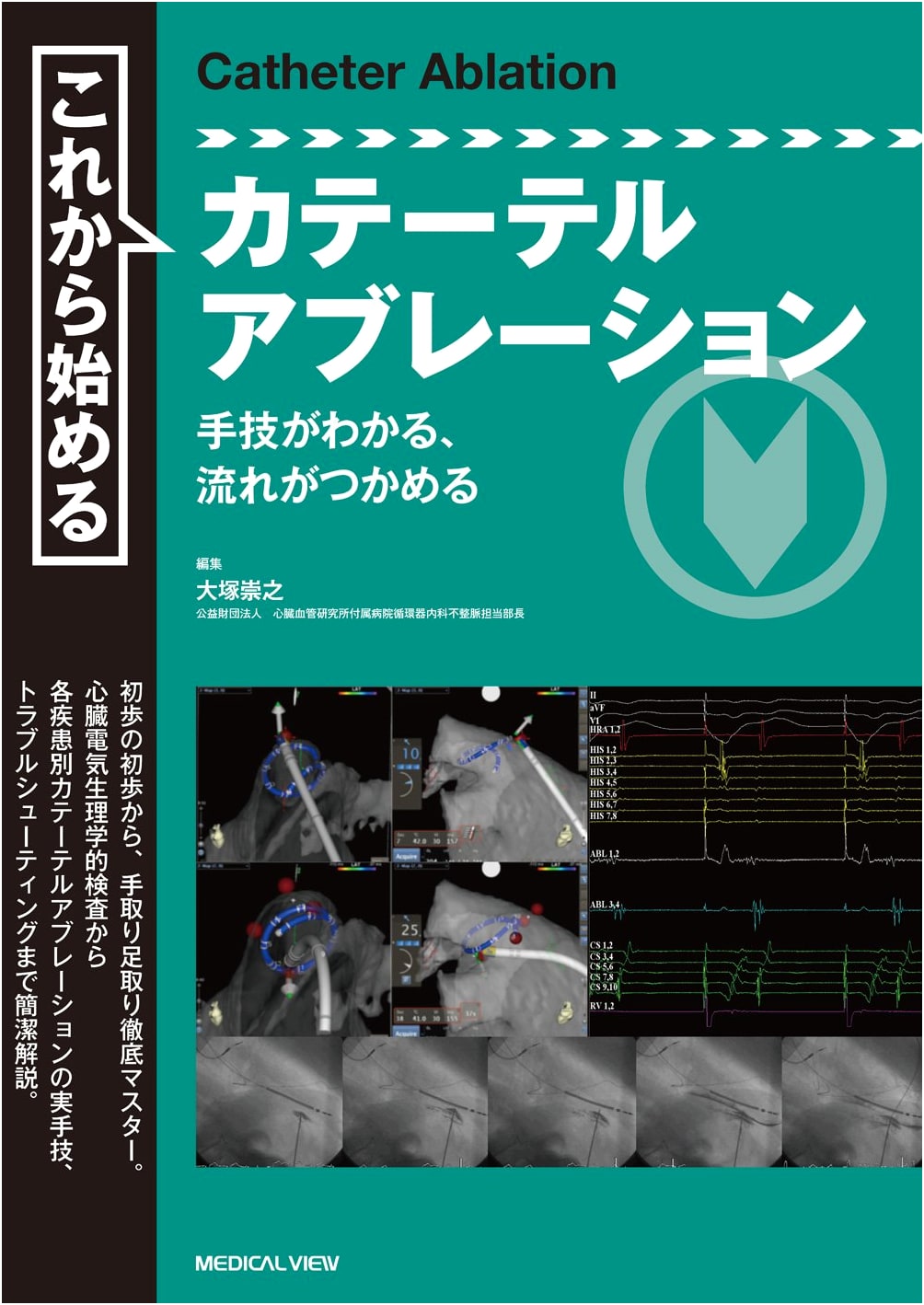 Starting Catheter Ablation: Understanding Techniques and Workflow