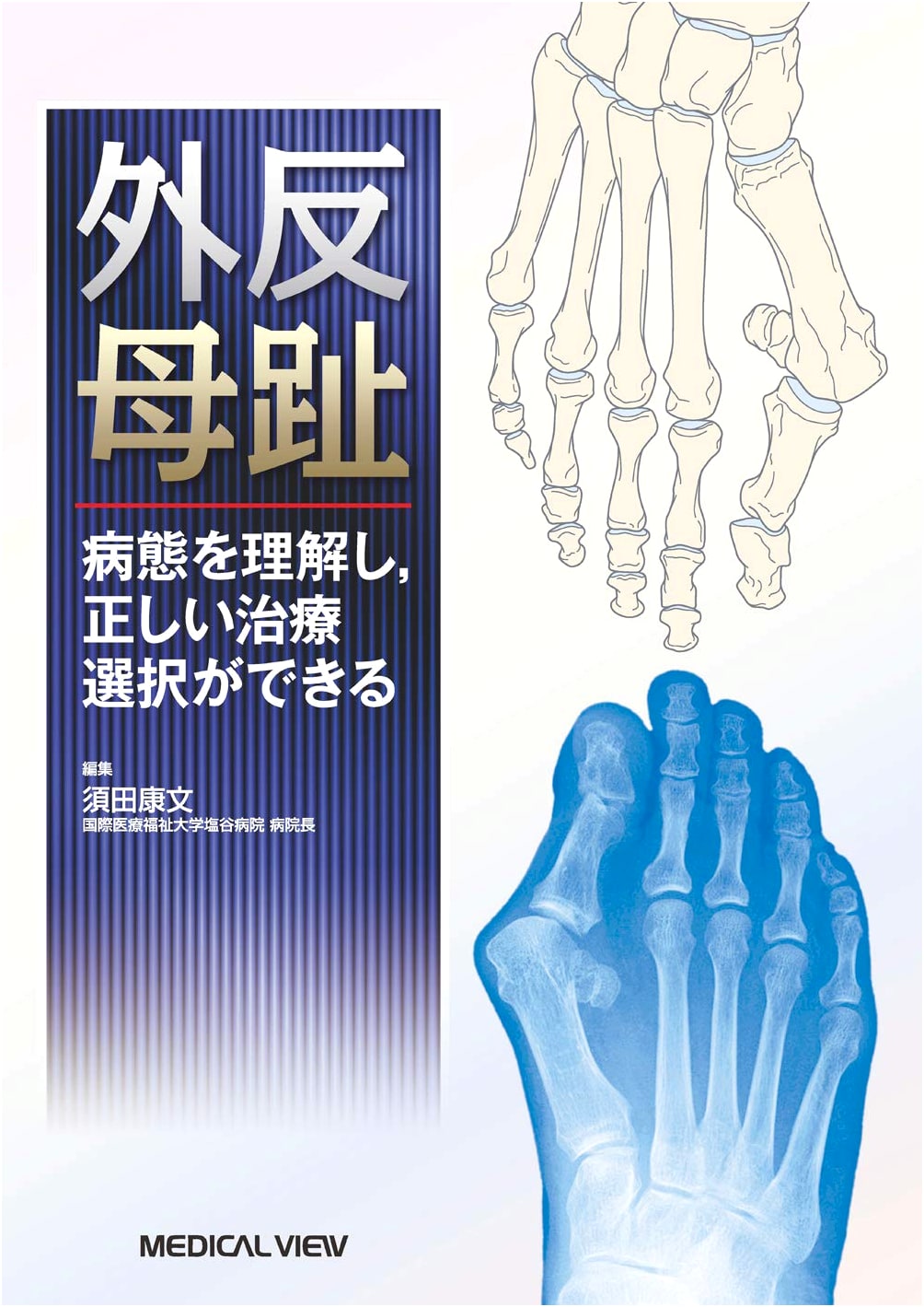 Bunions: Understanding Pathology and Choosing the Right Treatment