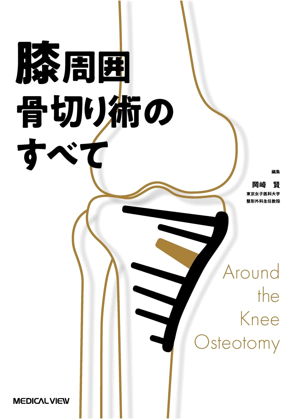 Everything About Osteotomy Around the Knee