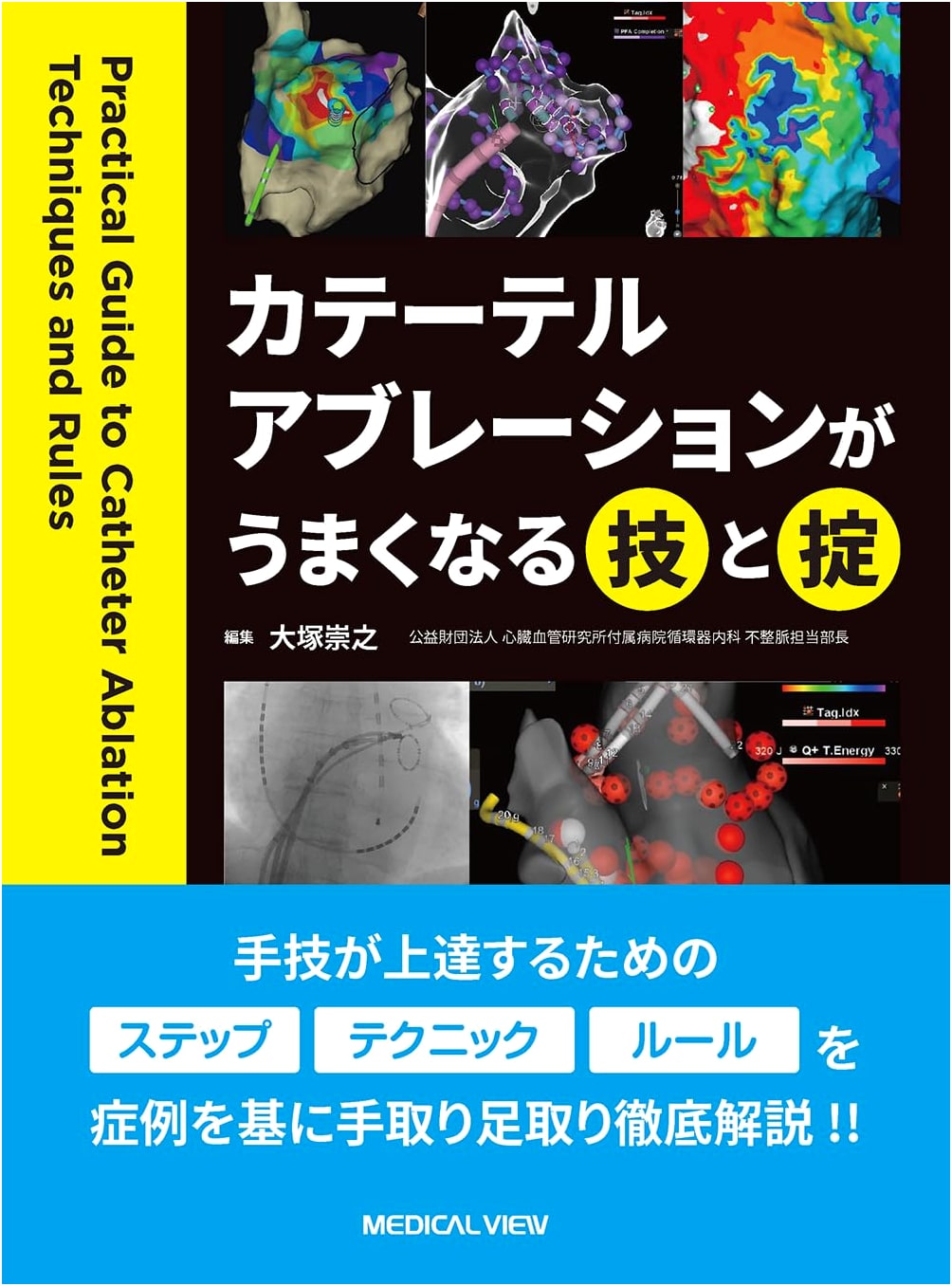 Techniques and Rules for Successful Catheter Ablation