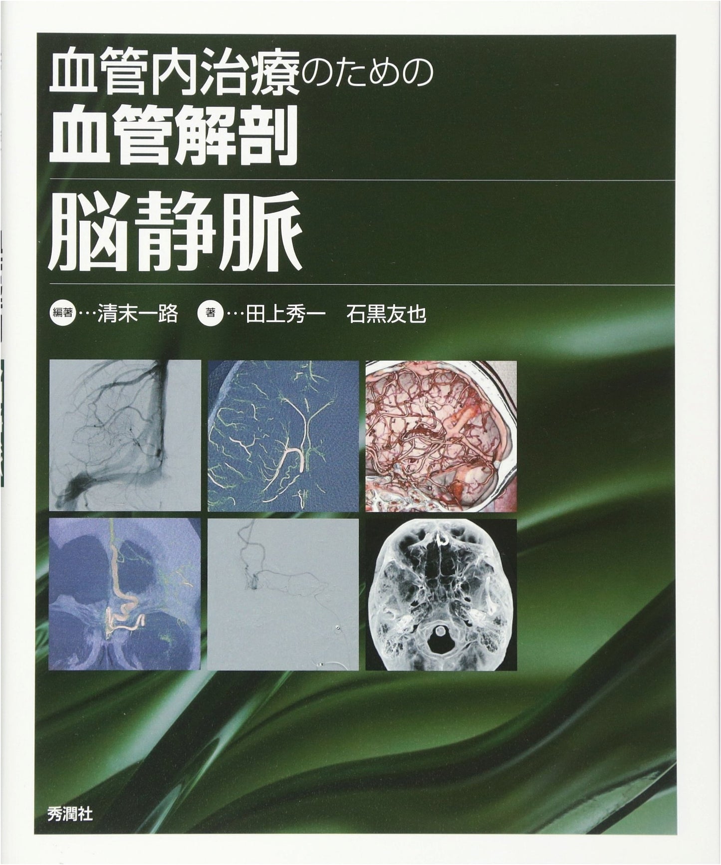 Vascular Anatomy for Endovascular Treatment: Cerebral Veins