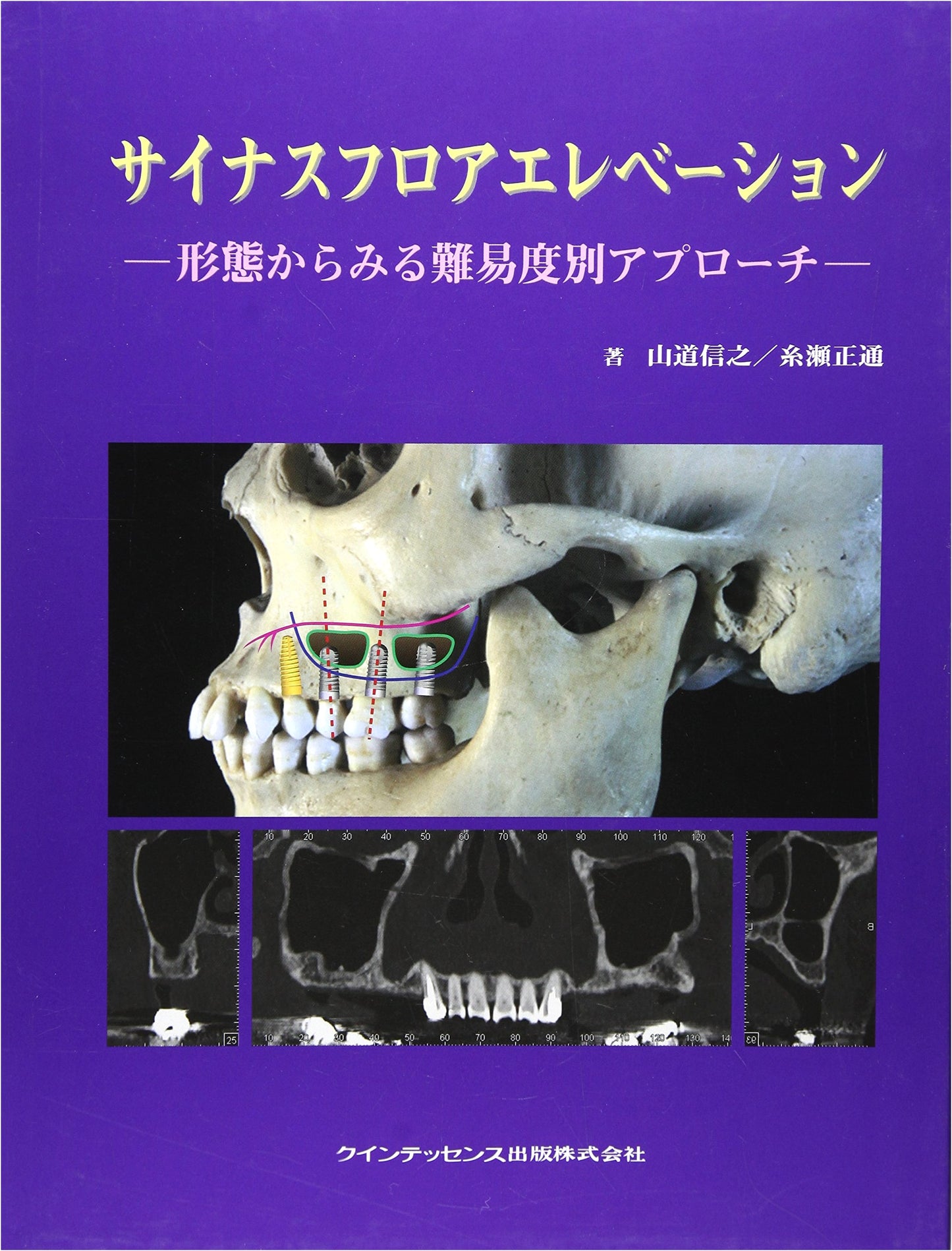 Sinus Floor Elevation: An Approach by Difficulty Level from Morphology