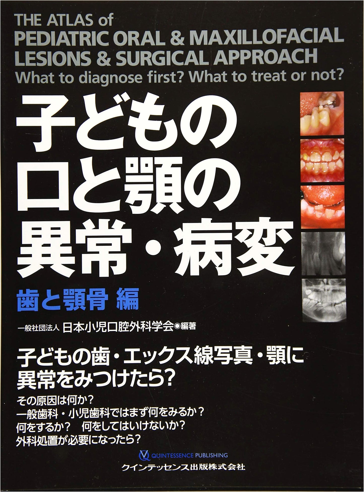 Pediatric Oral & Maxillofacial Disorders: Teeth and Jawbone Volume