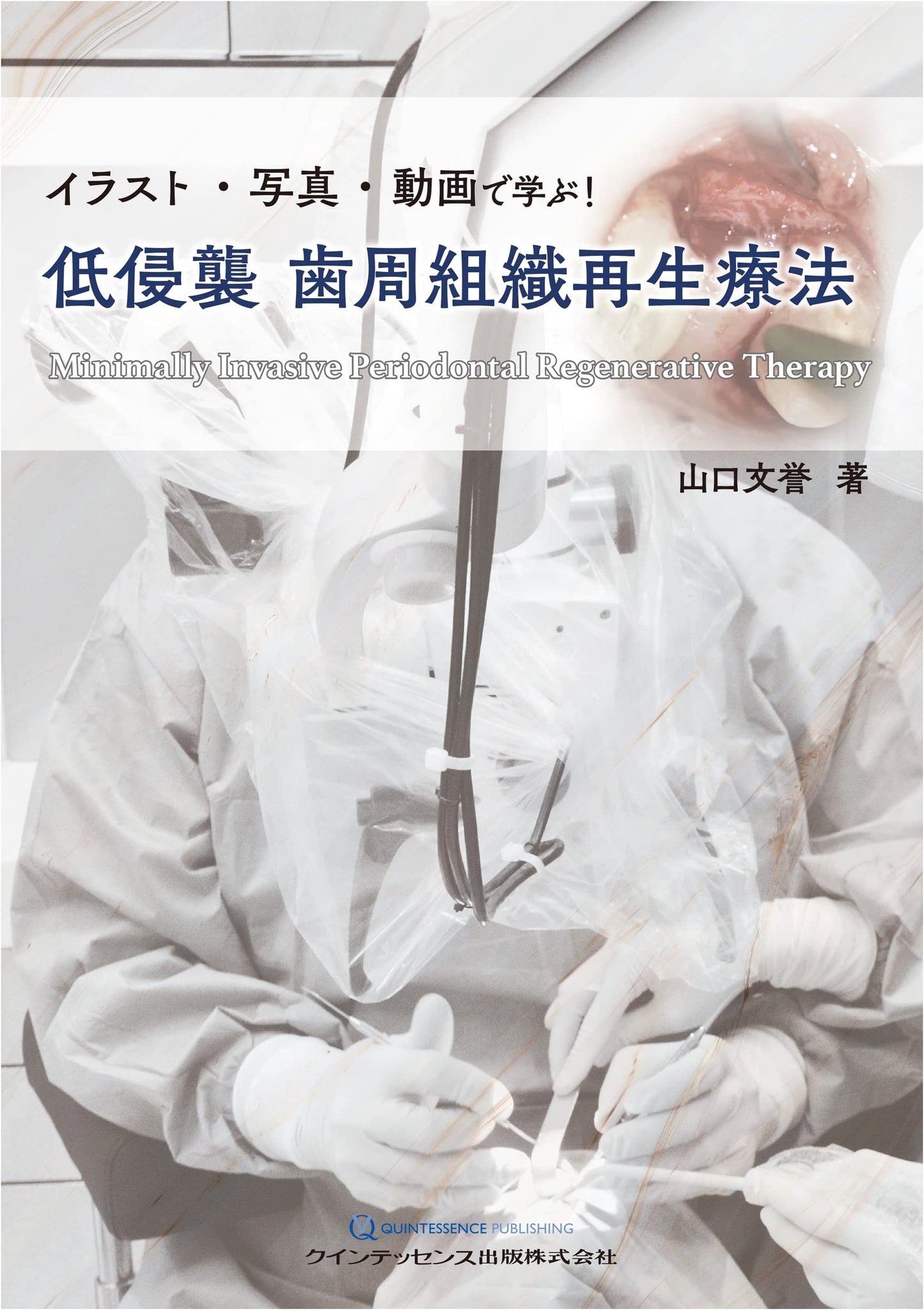 Low-Invasive Periodontal Tissue Regeneration Therapy: A Visual Guide with Illustrations, Photos, and Videos