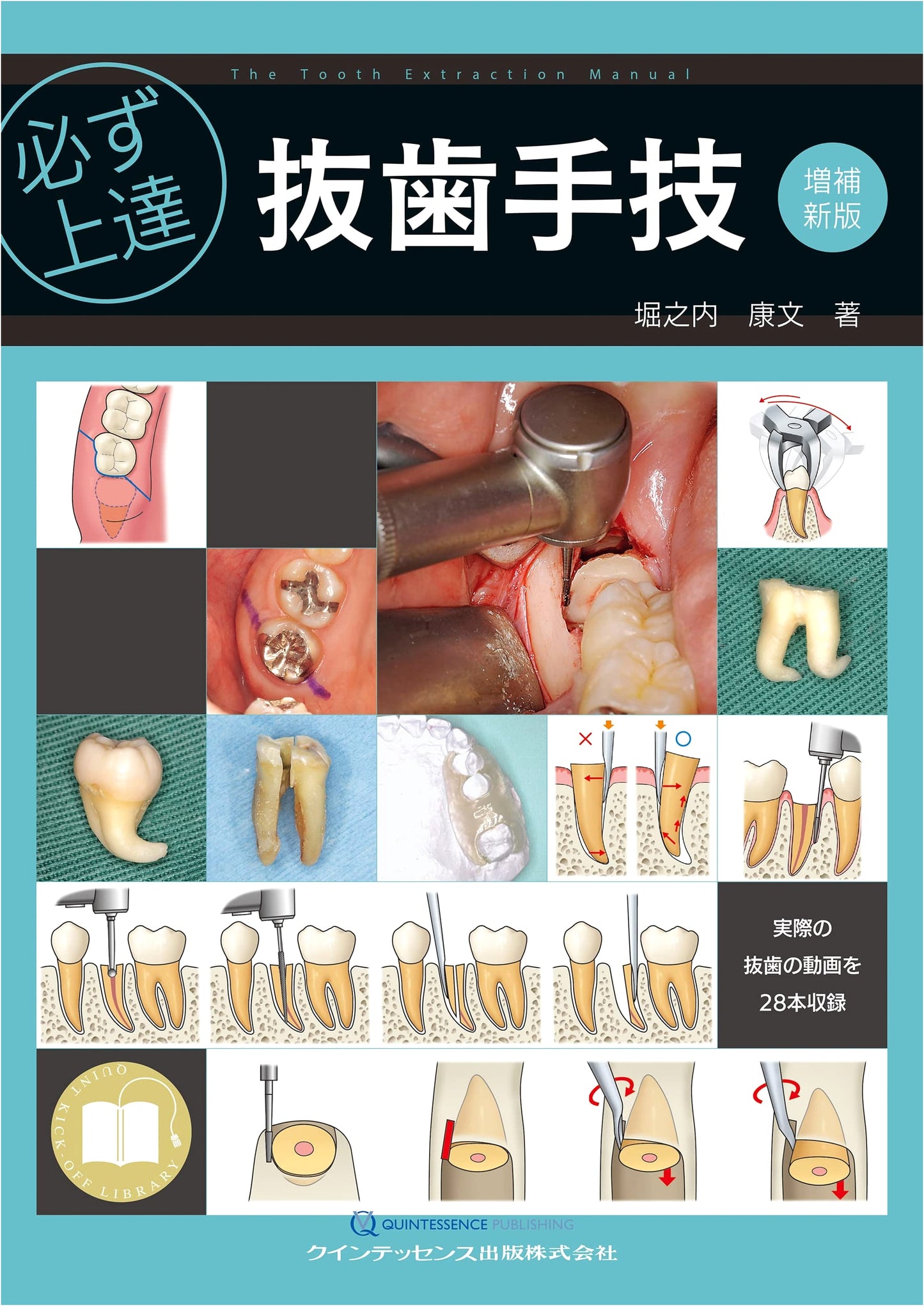 Guaranteed Mastery: Tooth Extraction Procedures, Expanded New Edition