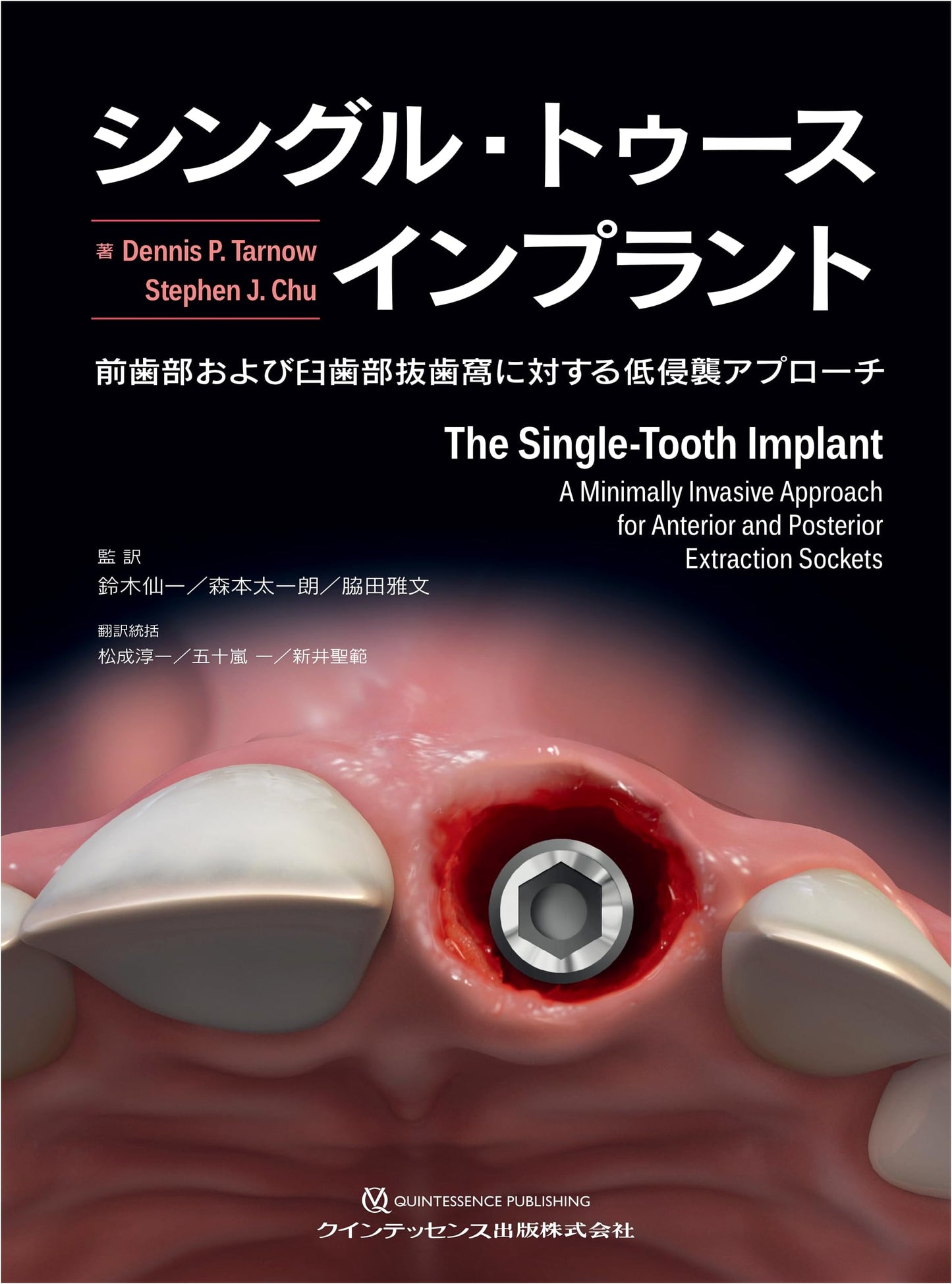 Single Tooth Implants: Minimally Invasive Approaches for Anterior & Posterior Extraction Sockets