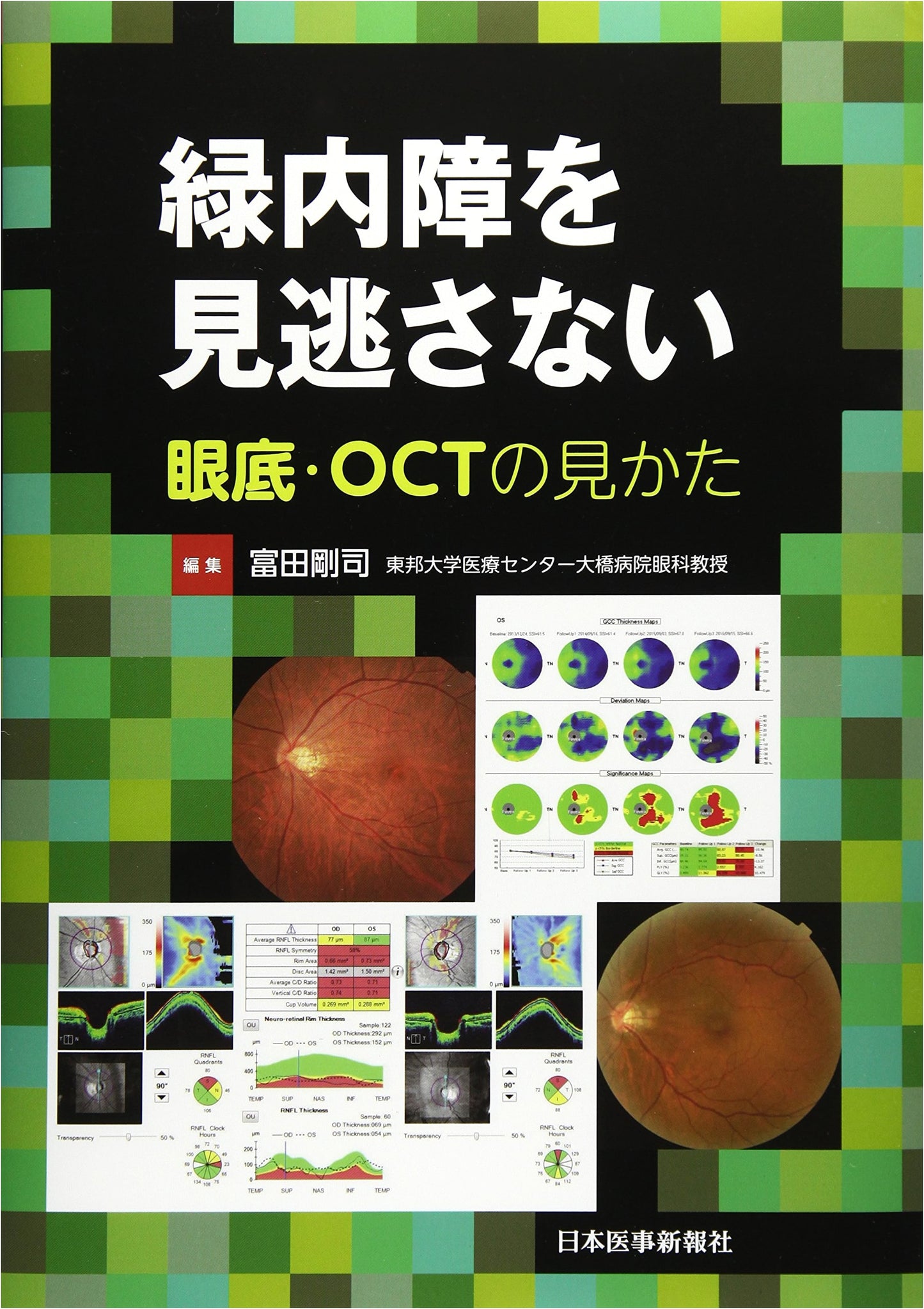 Glaucoma Detection: Interpreting Fundus and OCT Images for Missed Diagnoses