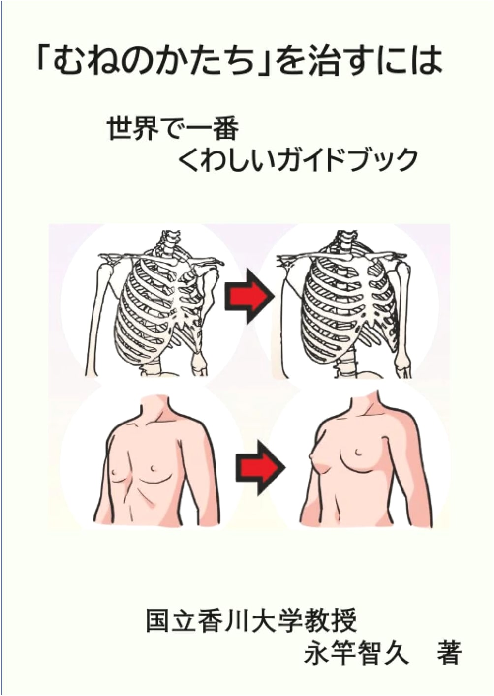 How to Treat Chest Deformities: The World's Most Comprehensive Guidebook for Patients