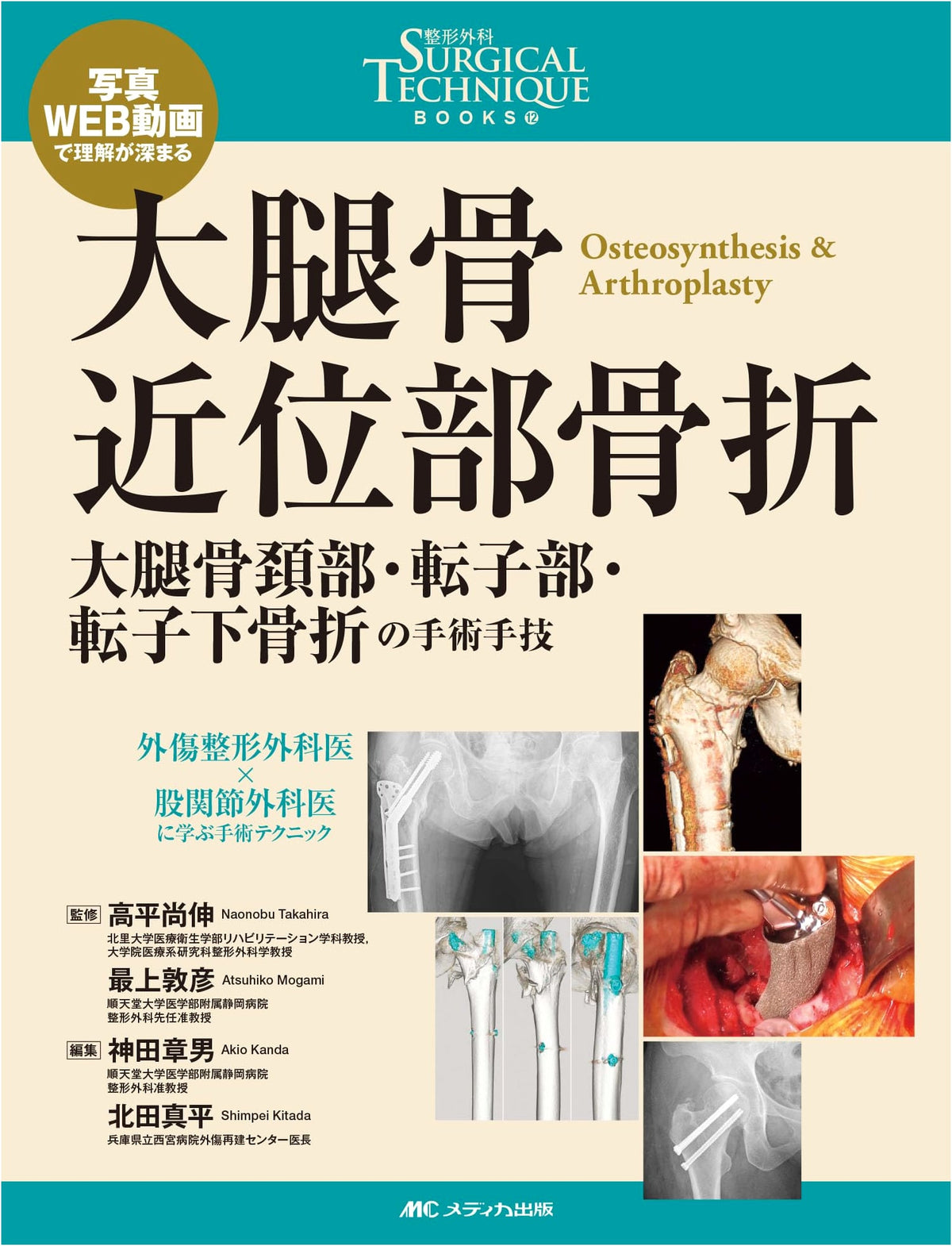 Proximal Femoral Fractures: Surgical Techniques for Neck, Trochanteric, & Subtrochanteric Fractures