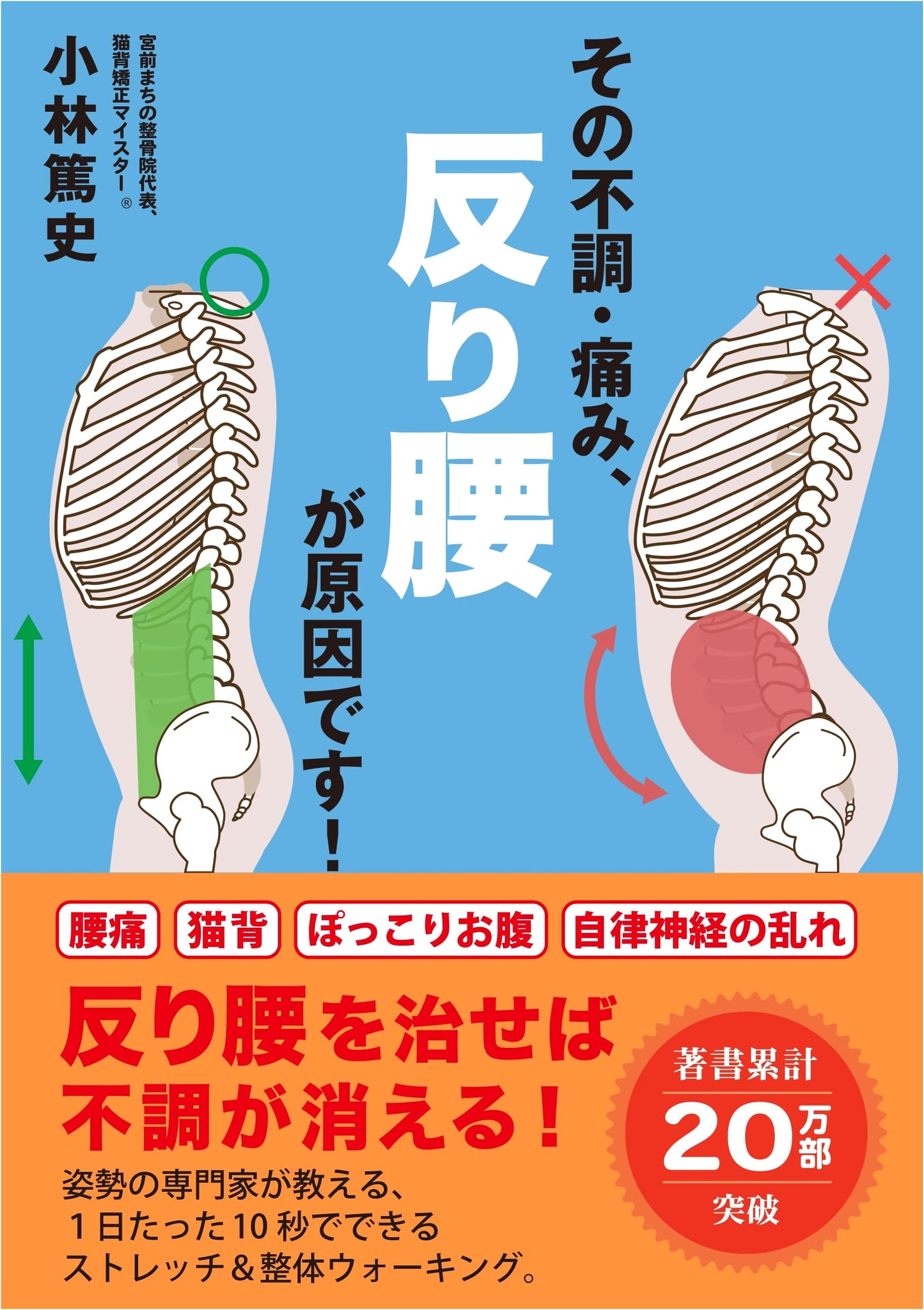 Swayback is the Root Cause of Your Discomfort and Pain!
