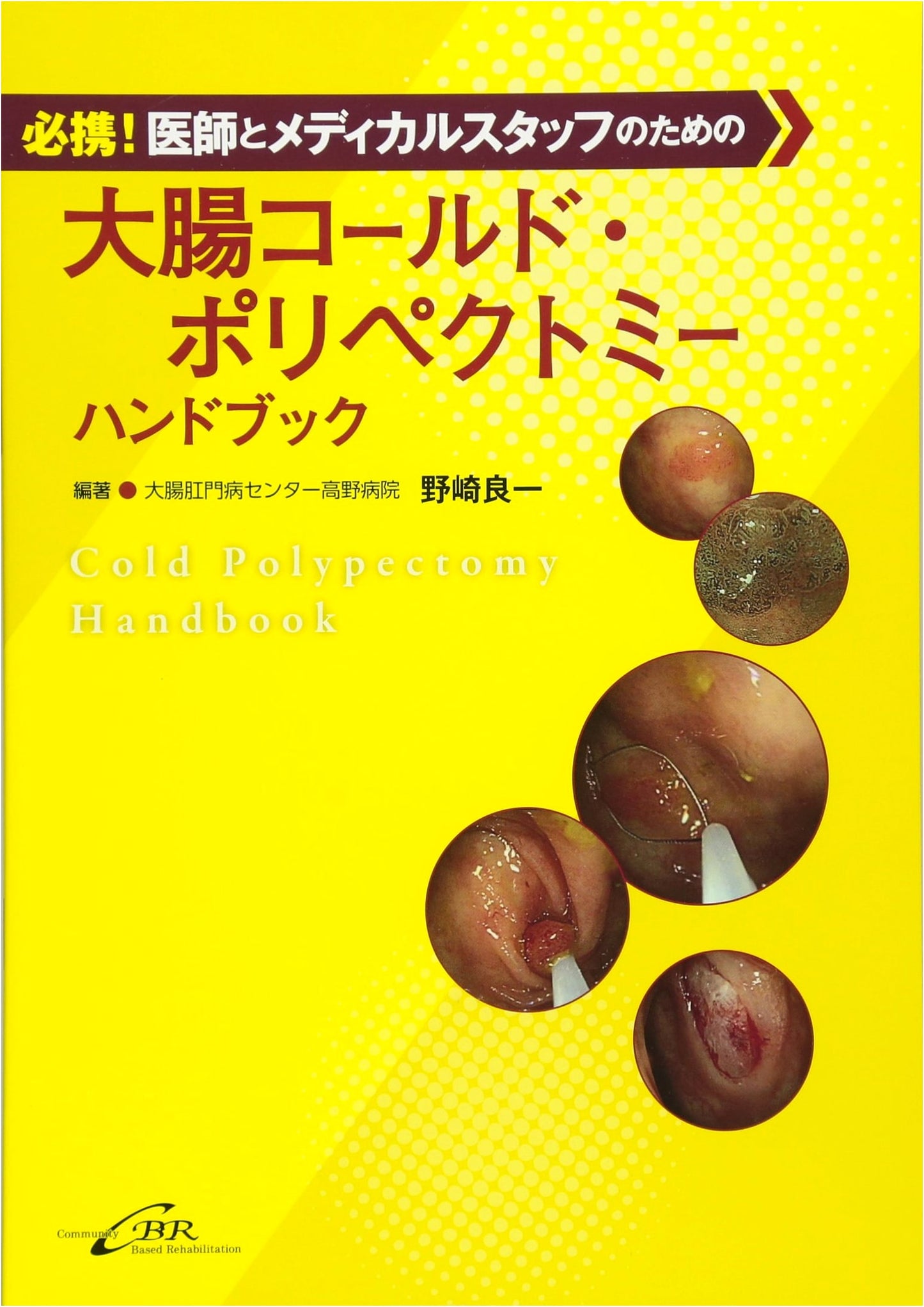 Essential Guide to Colonic Cold Polypectomy for Medical Professionals