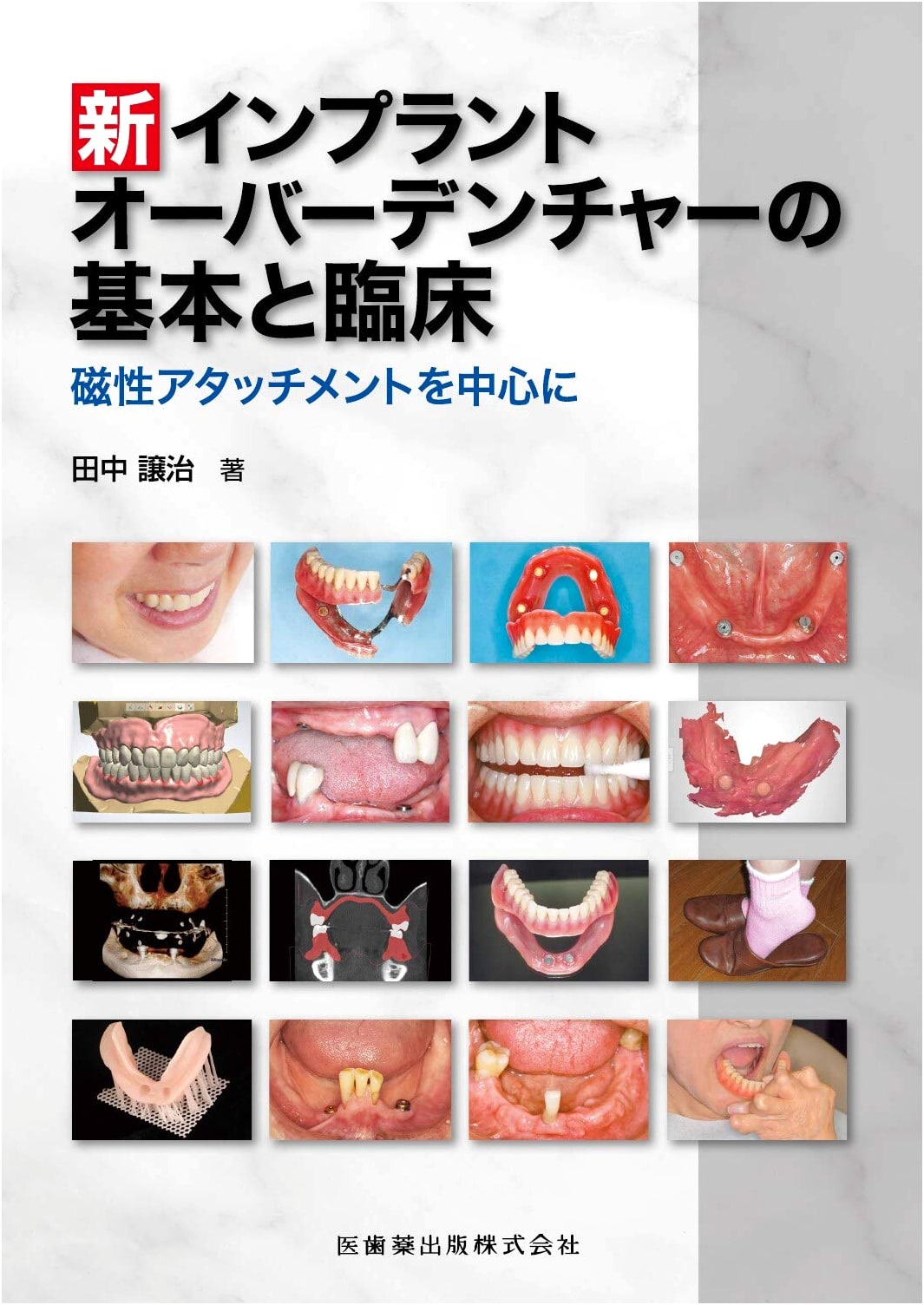 New Implant Overdenture: Fundamentals & Clinical Practice of Magnetic Attachments