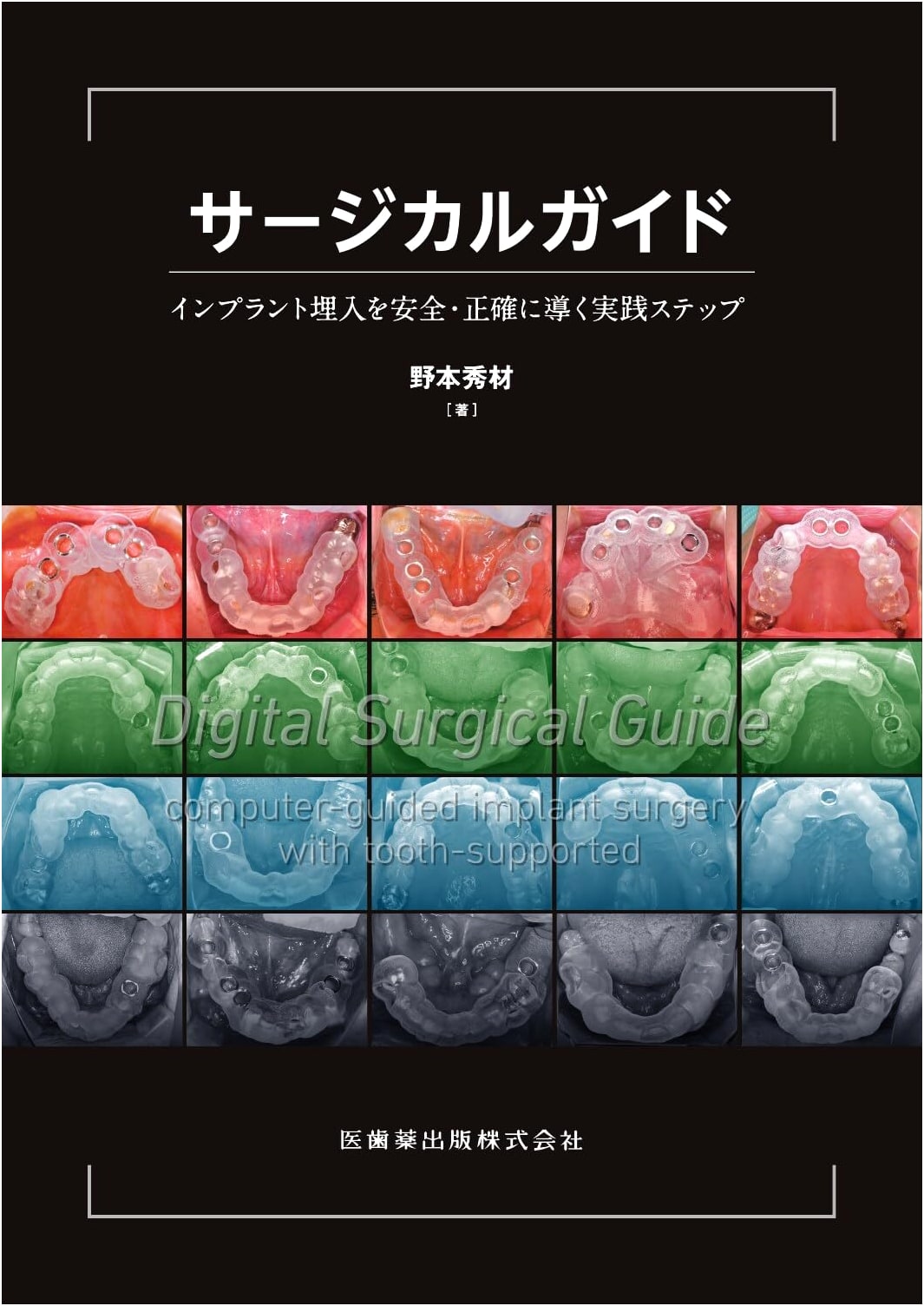 Surgical Guide: Practical Steps for Safe and Precise Implant Placement