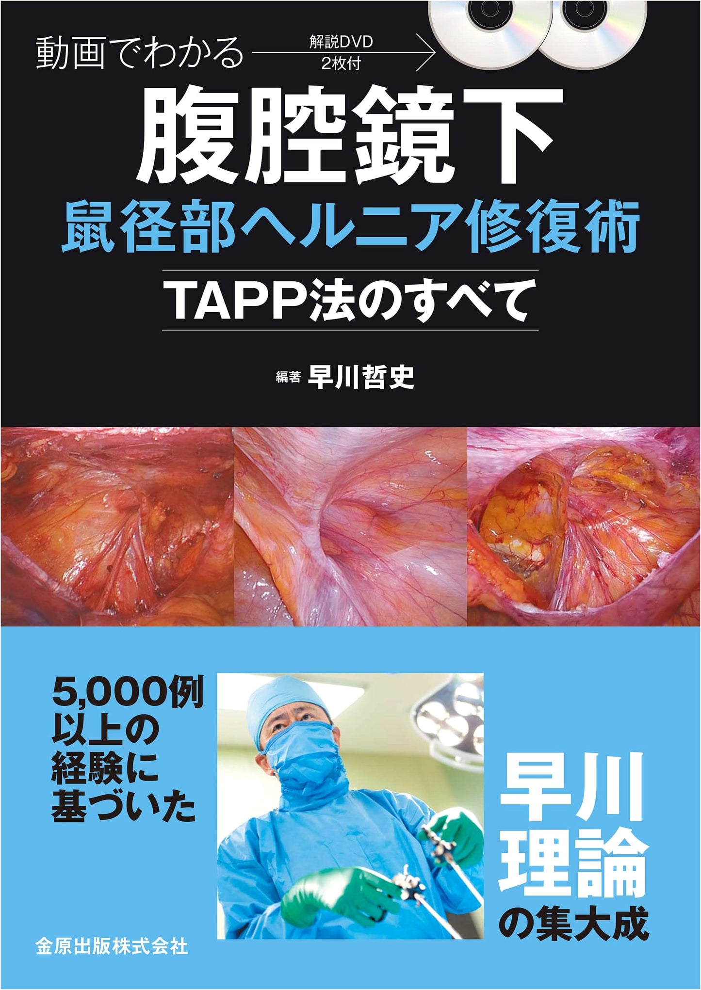 Laparoscopic Inguinal Hernia Repair: Mastering TAPP Procedure with Video Guides