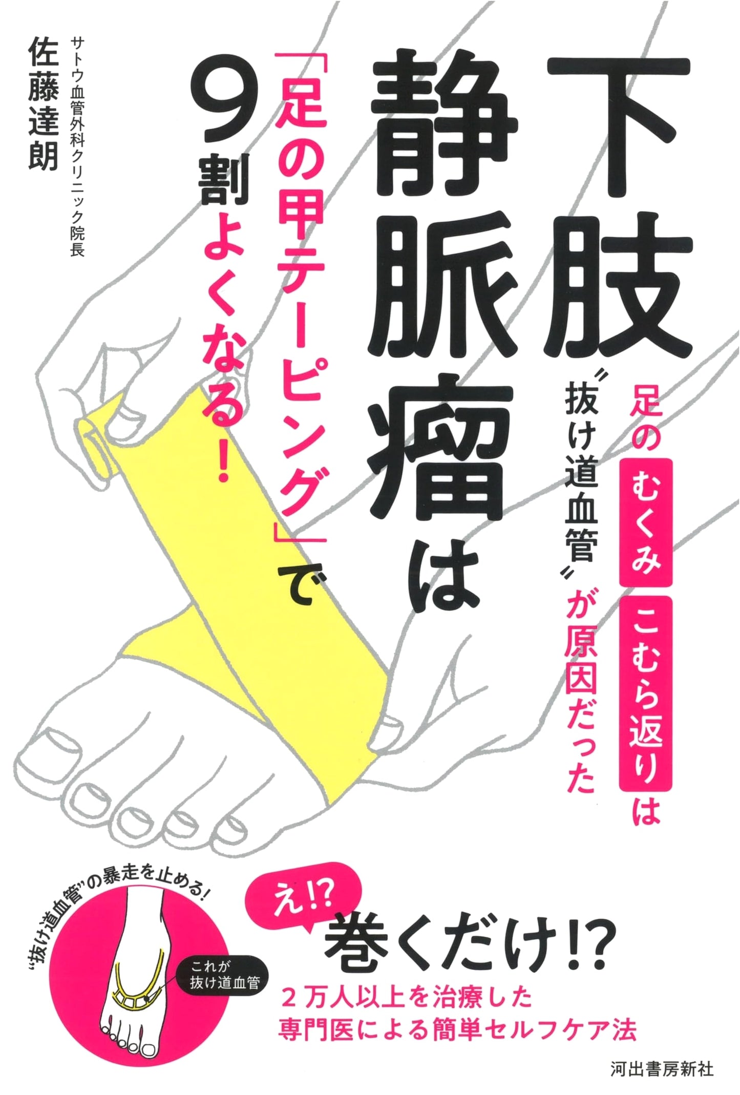 Heal Varicose Veins 90% with Instep Taping: New Cause for Swelling & Cramps