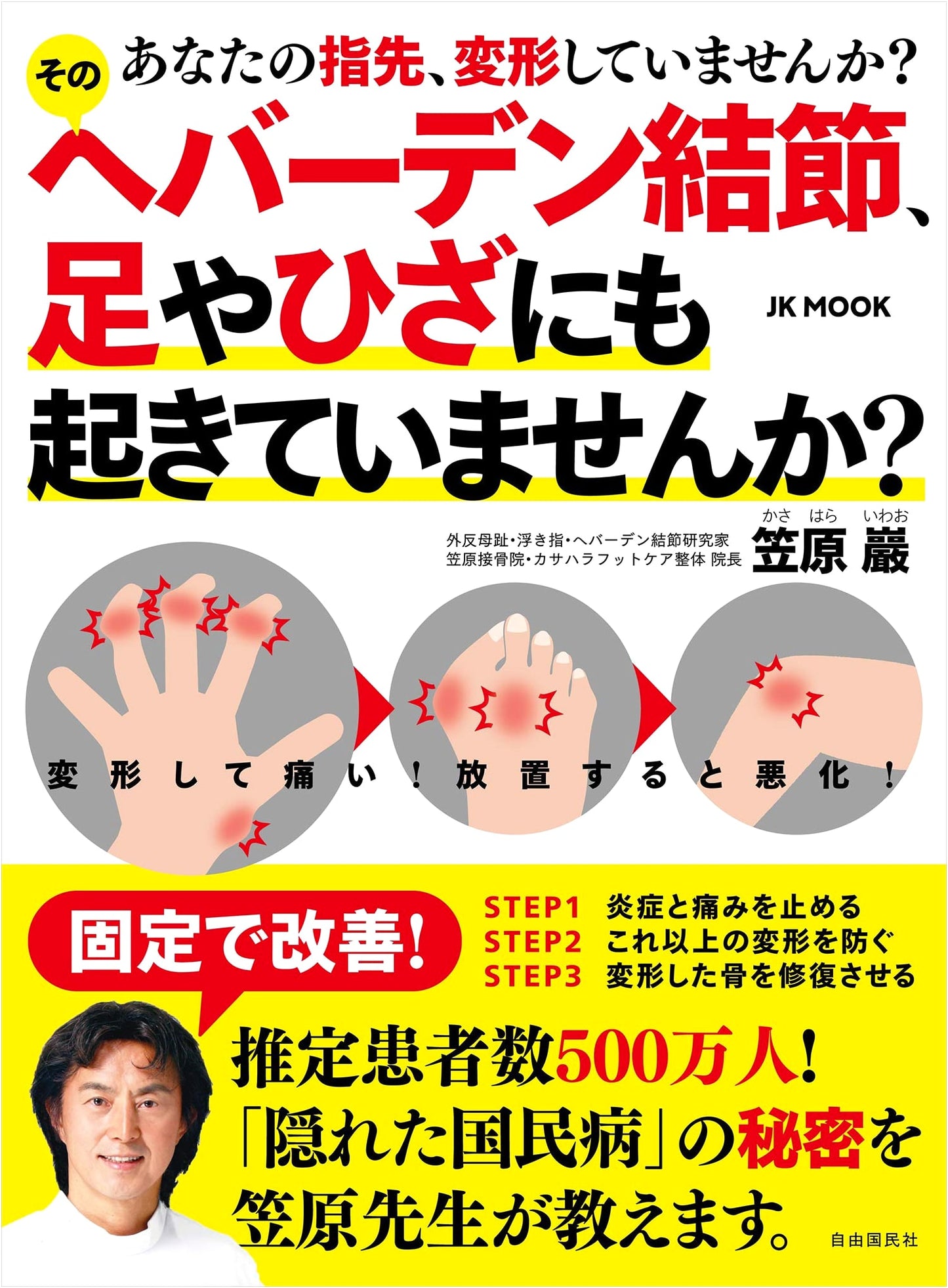 Heberden's Nodes: Are Your Finger Joints Deformed? Also Affecting Feet & Knees? (JK MOOK)