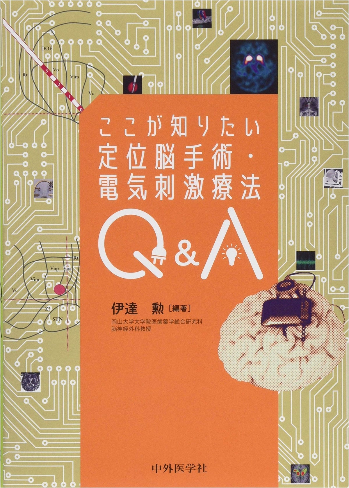 Stereotactic Brain Surgery & Electrical Stimulation Therapy Q&A: What You Want to Know