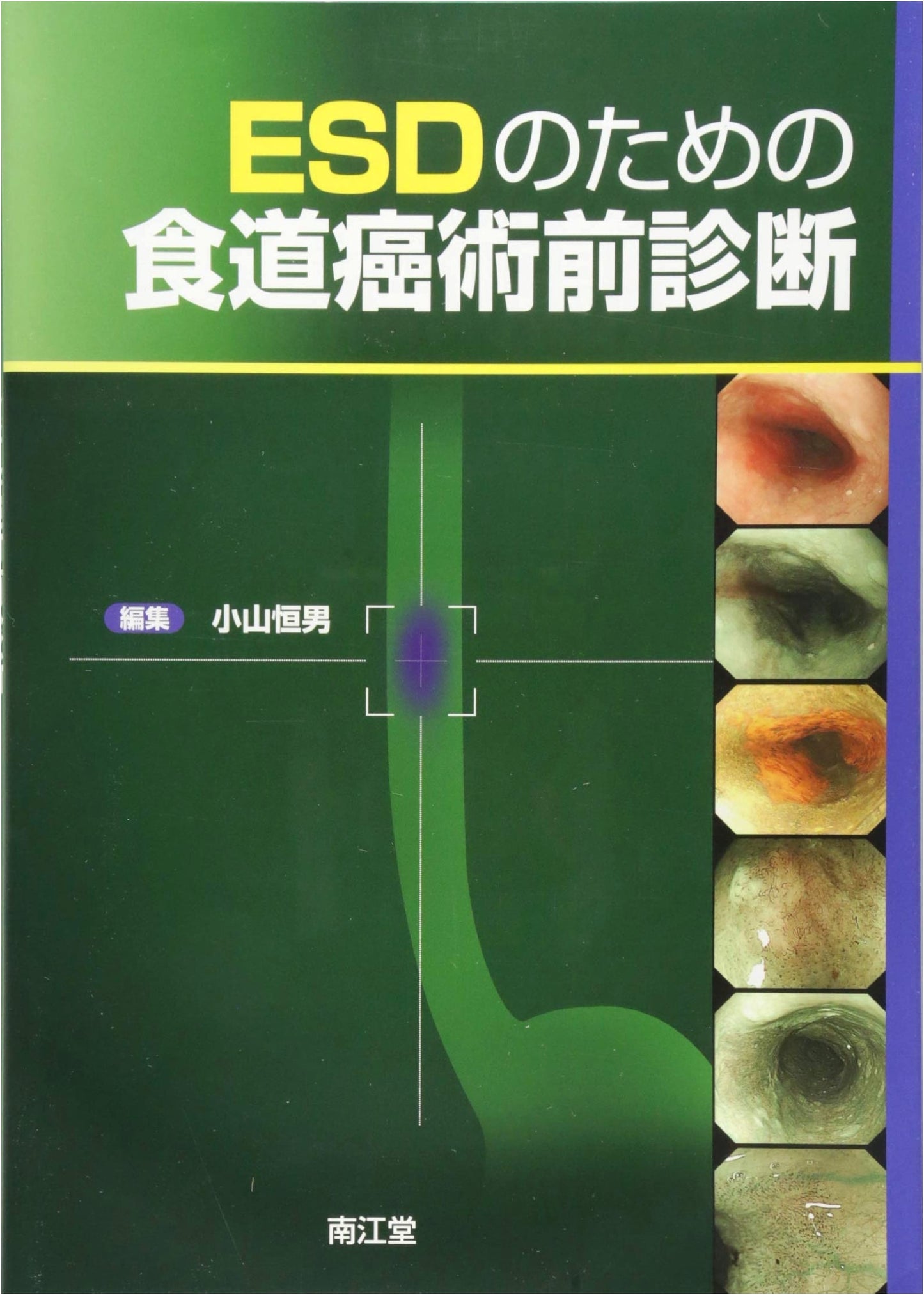 Preoperative Diagnosis of Esophageal Cancer for ESD