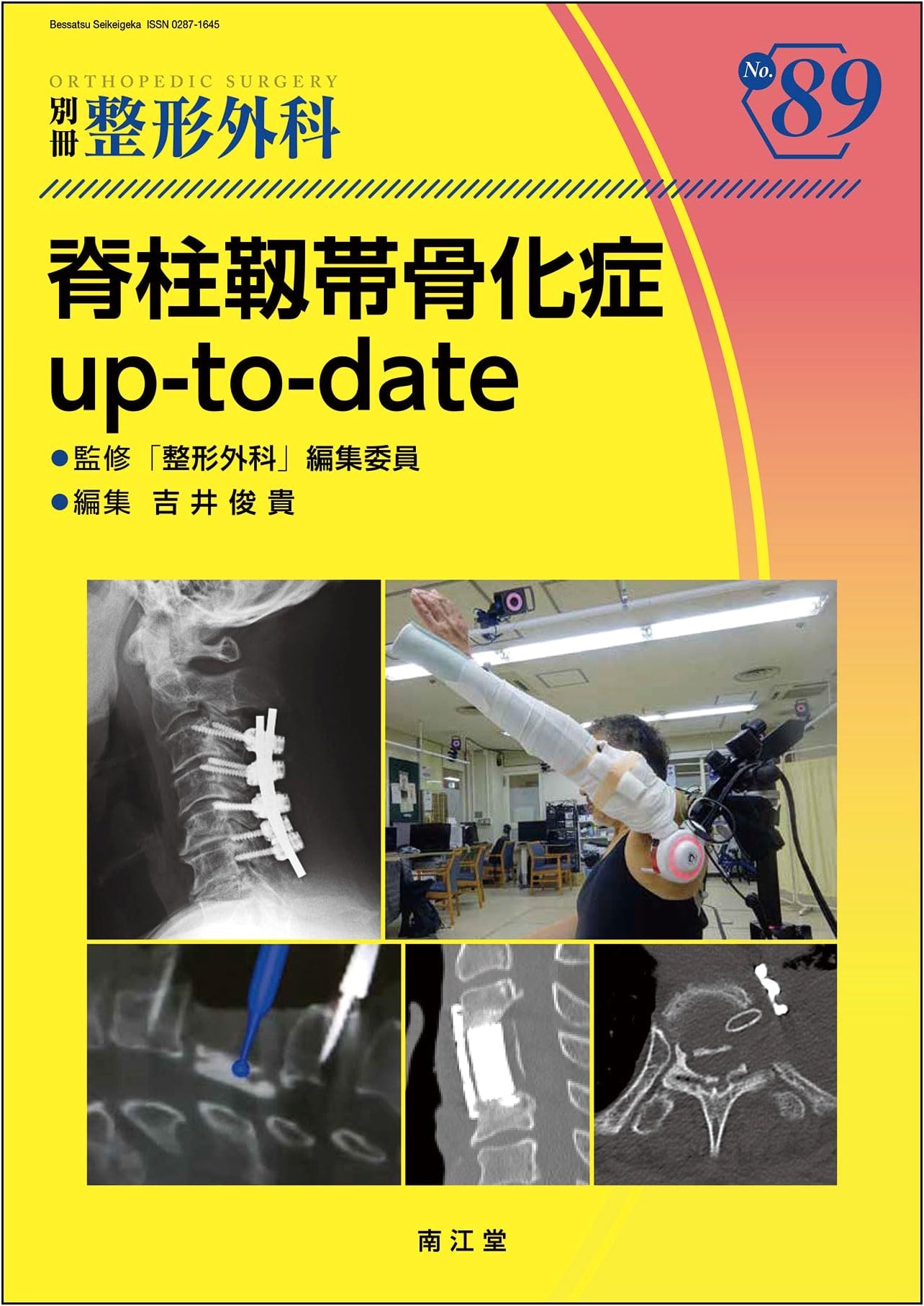 Spinal Ligament Ossification: Up-to-Date Review (Orthopedic Surgery Special)