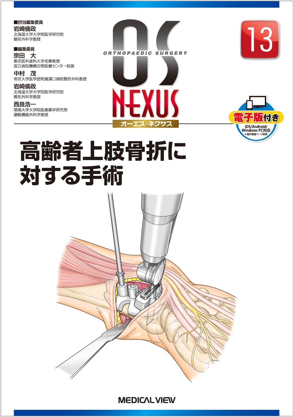 Surgery for Upper Limb Fractures in the Elderly (OS NEXUS w/ Digital Ed. 13)