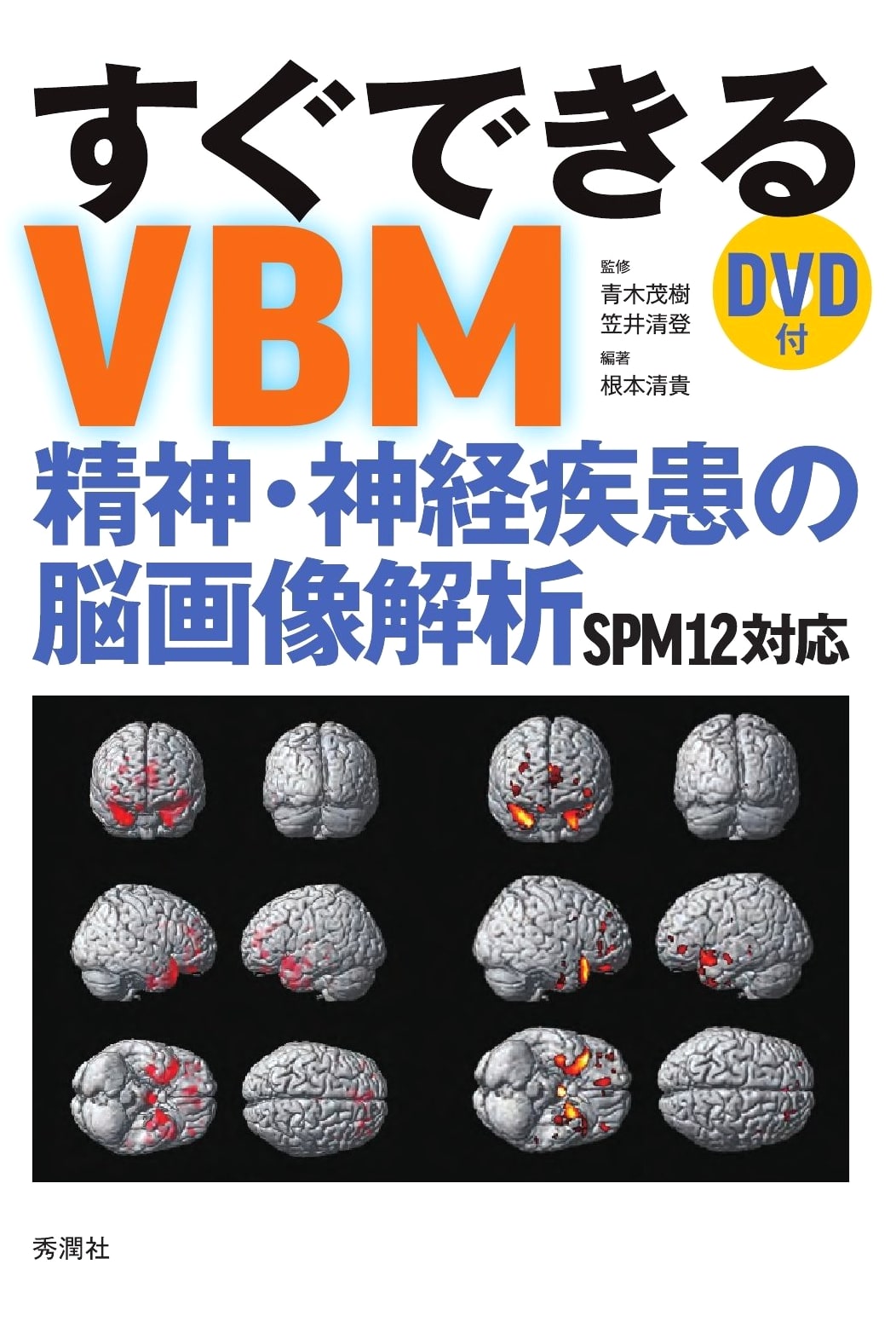 Easy VBM: Brain Imaging Analysis for Psychiatric & Neuro Disorders (SPM12, DVD)