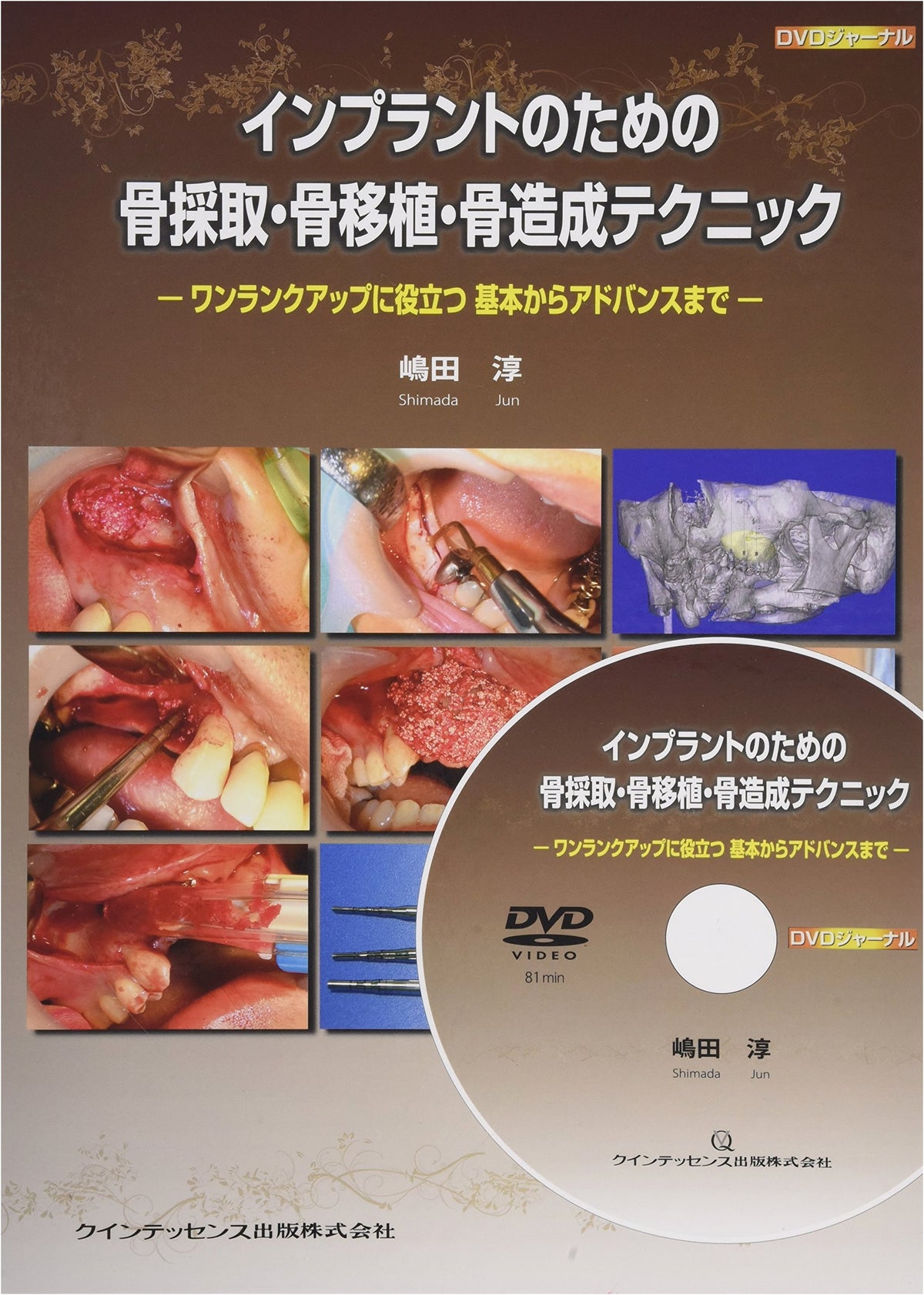 Bone Harvesting, Grafting, and Regeneration Techniques for Implants (DVD Journal)