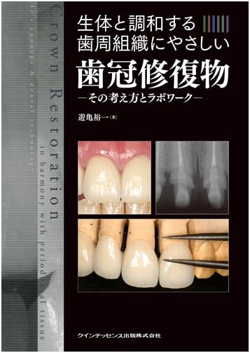Biocompatible Crown Restorations: Gentle to Periodontal Tissues