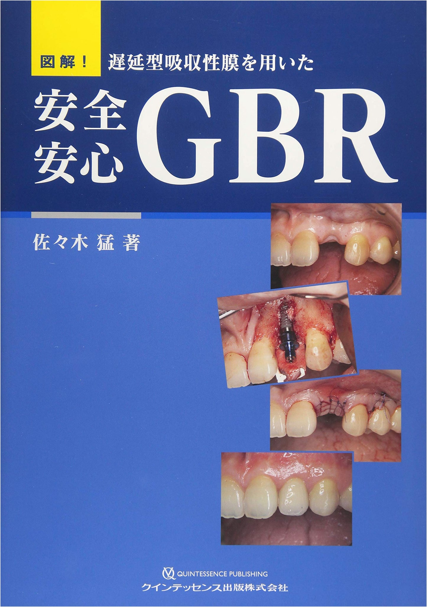 Illustrated! Safe & Secure GBR Using Delayed Absorbable Membranes