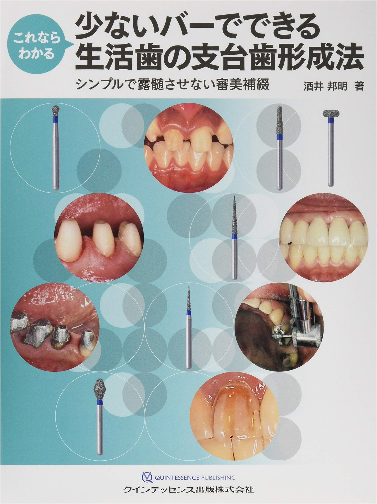 Easy Abutment Tooth Preparation for Vital Teeth Using Few Burs
