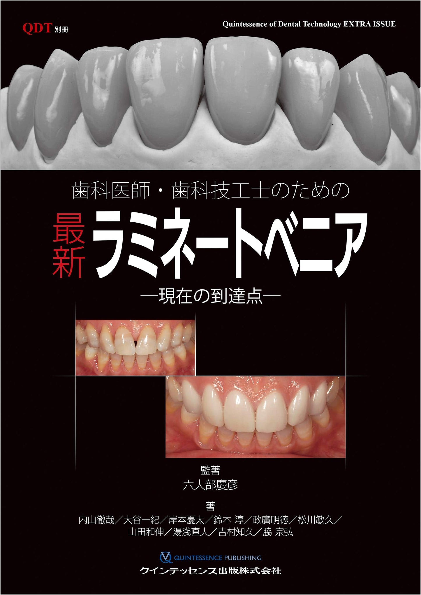 Latest Laminate Veneers for Dentists & Technicians: Current Advancements (QDT Special)