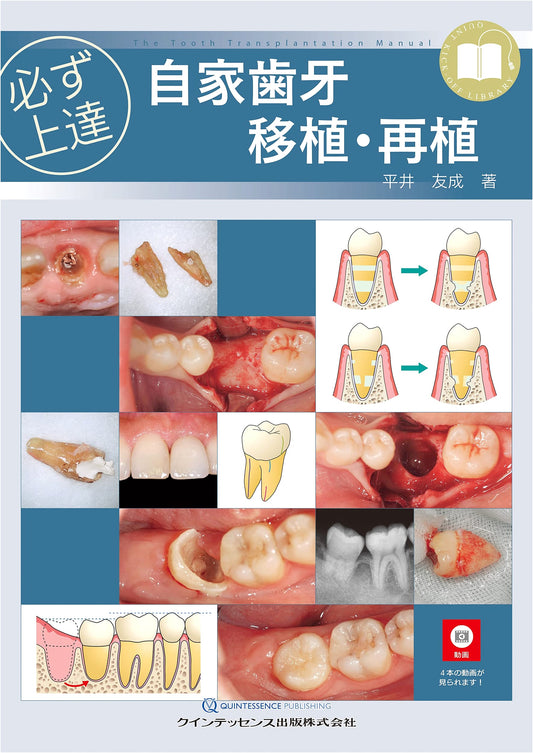 Mastering Autogenous Tooth Transplantation & Replantation: A Practical Guide