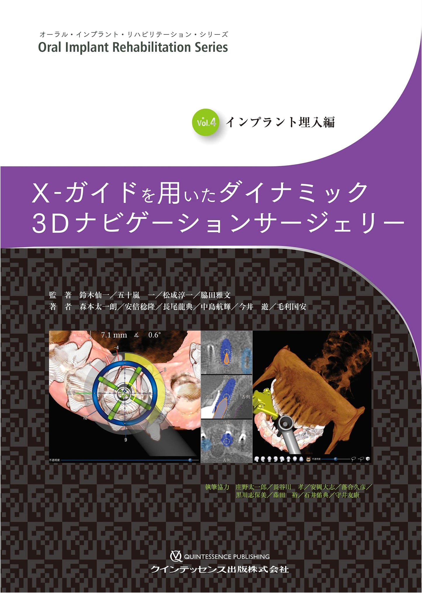 Oral Implant Rehabilitation Vol. 4: X-Guide Dynamic 3D Navigation Surgery & Implant Placement