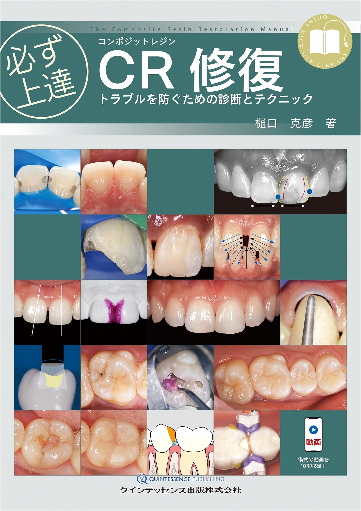 Mastering Composite Resin Restoration: Diagnosis & Techniques to Prevent Trouble