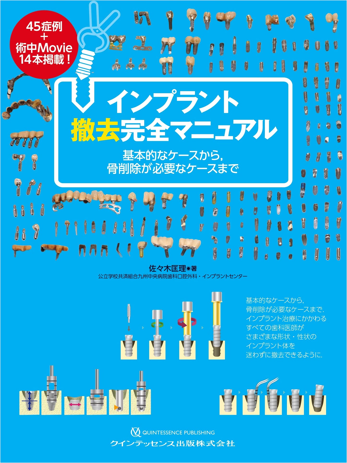 Complete Manual for Implant Removal: From Basic to Bone Resection Cases