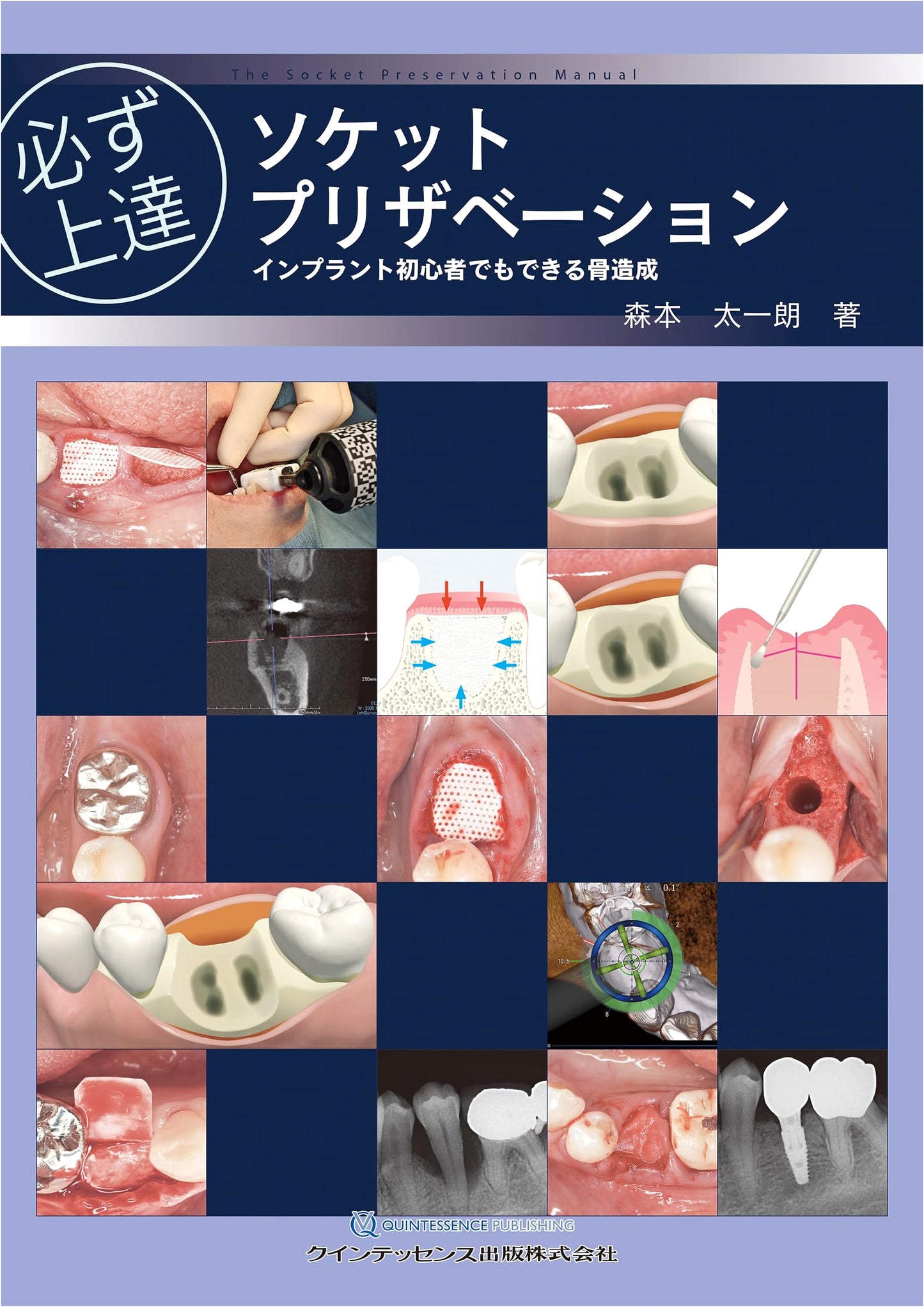 Mastering Socket Preservation: Bone Grafting for Implant Beginners (Mastery Series)