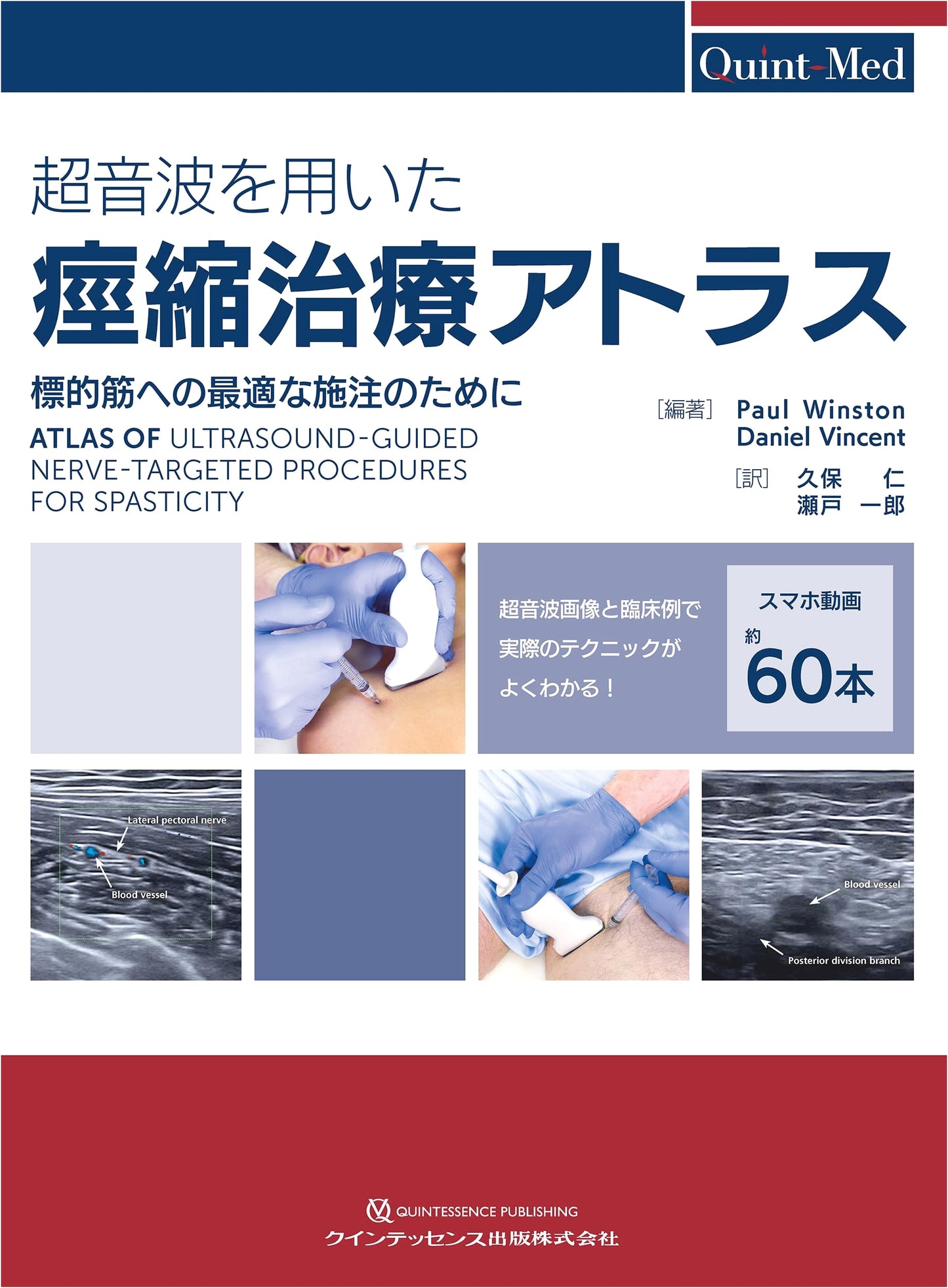 Ultrasound-Guided Atlas for Spasticity Treatment: Optimal Injections to Target Muscles