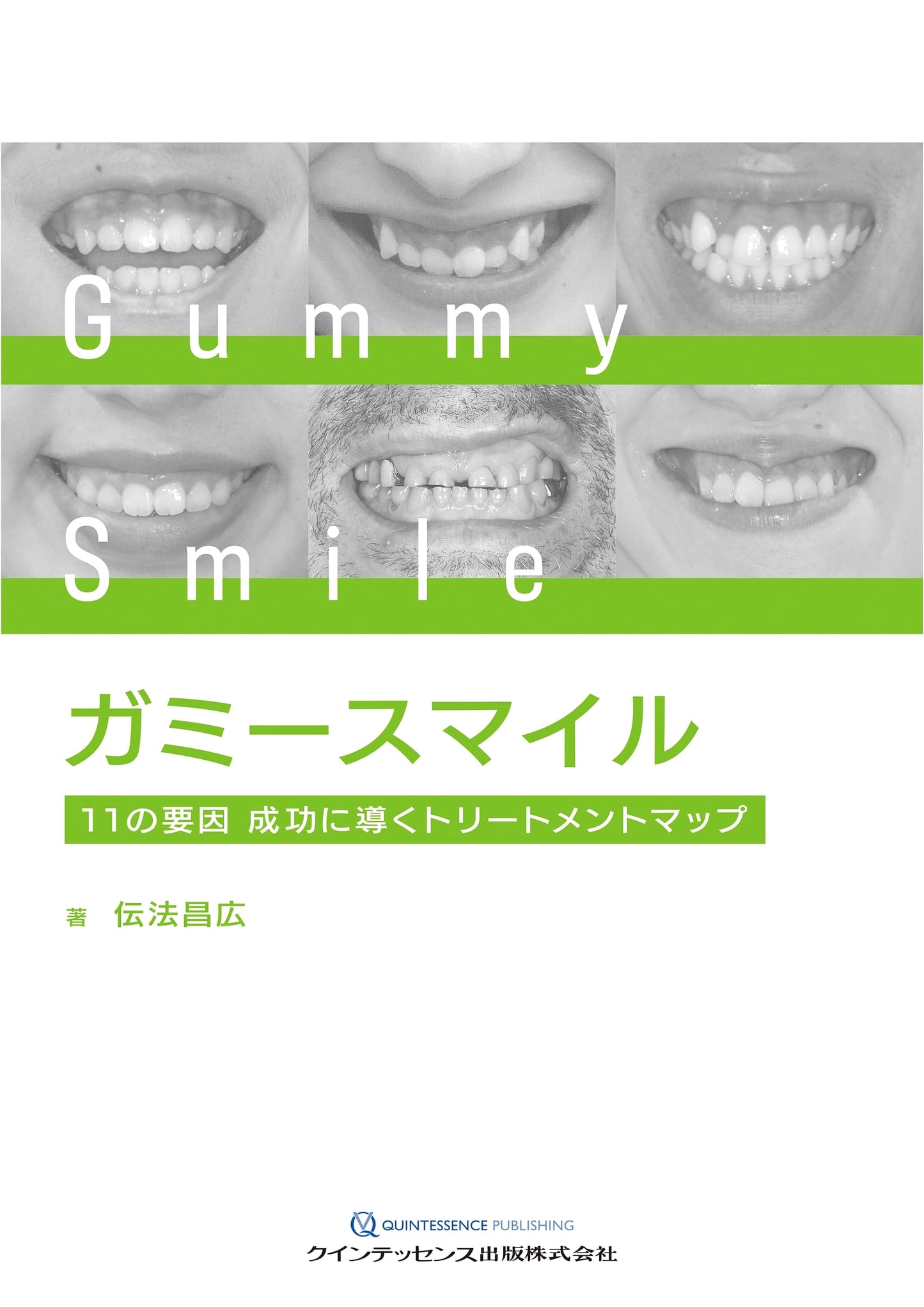 Gummy Smile: 11 Factors and a Treatment Map for Success