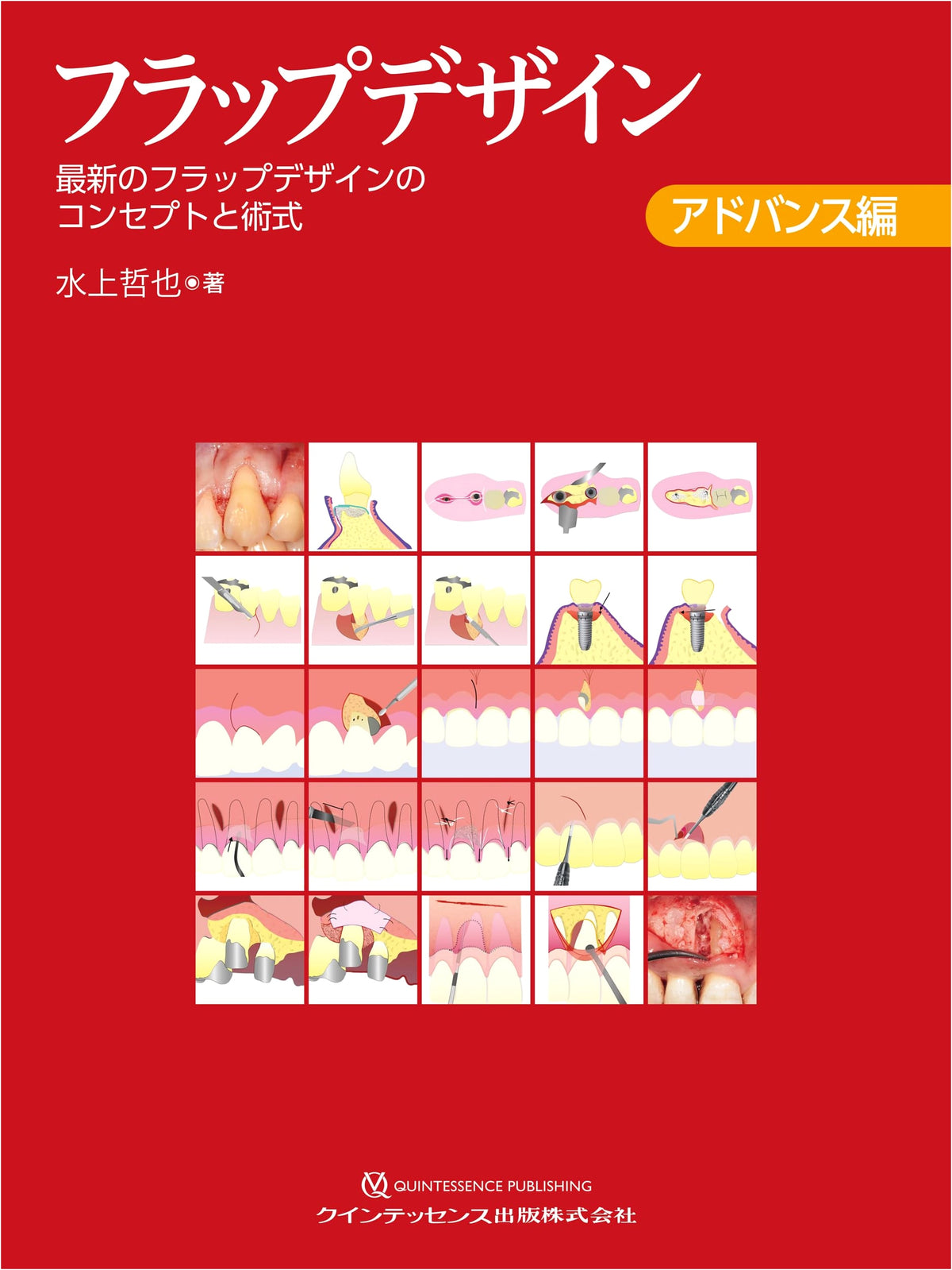 Flap Design Advanced Edition: Concepts and Procedures in Latest Flap Design