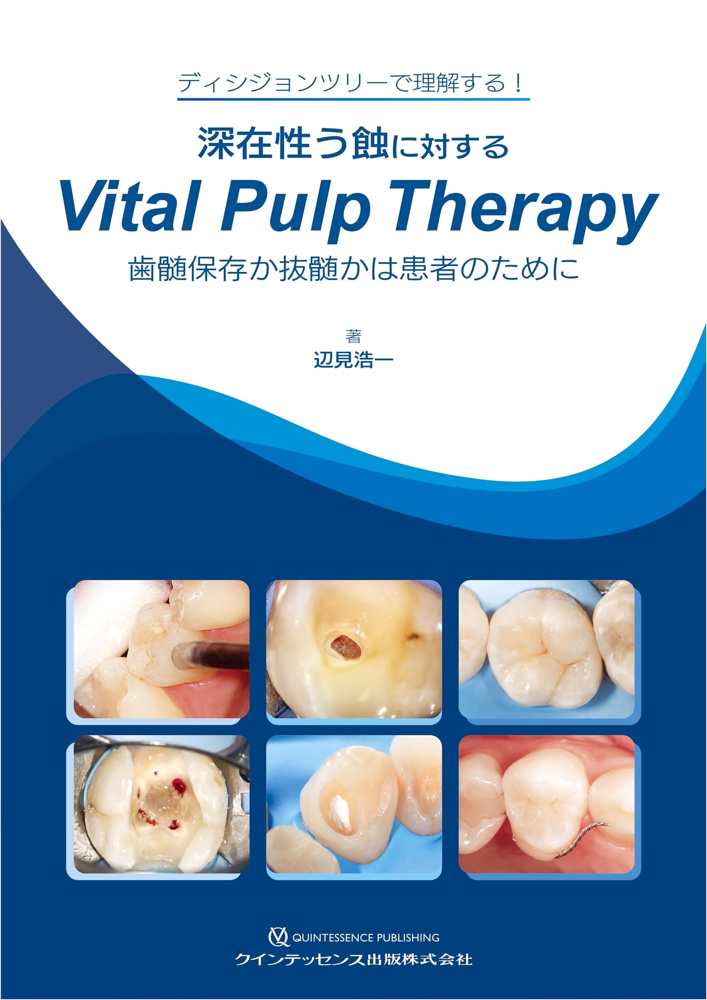 Vital Pulp Therapy for Deep Caries: Pulp Preservation or Extraction for the Patient