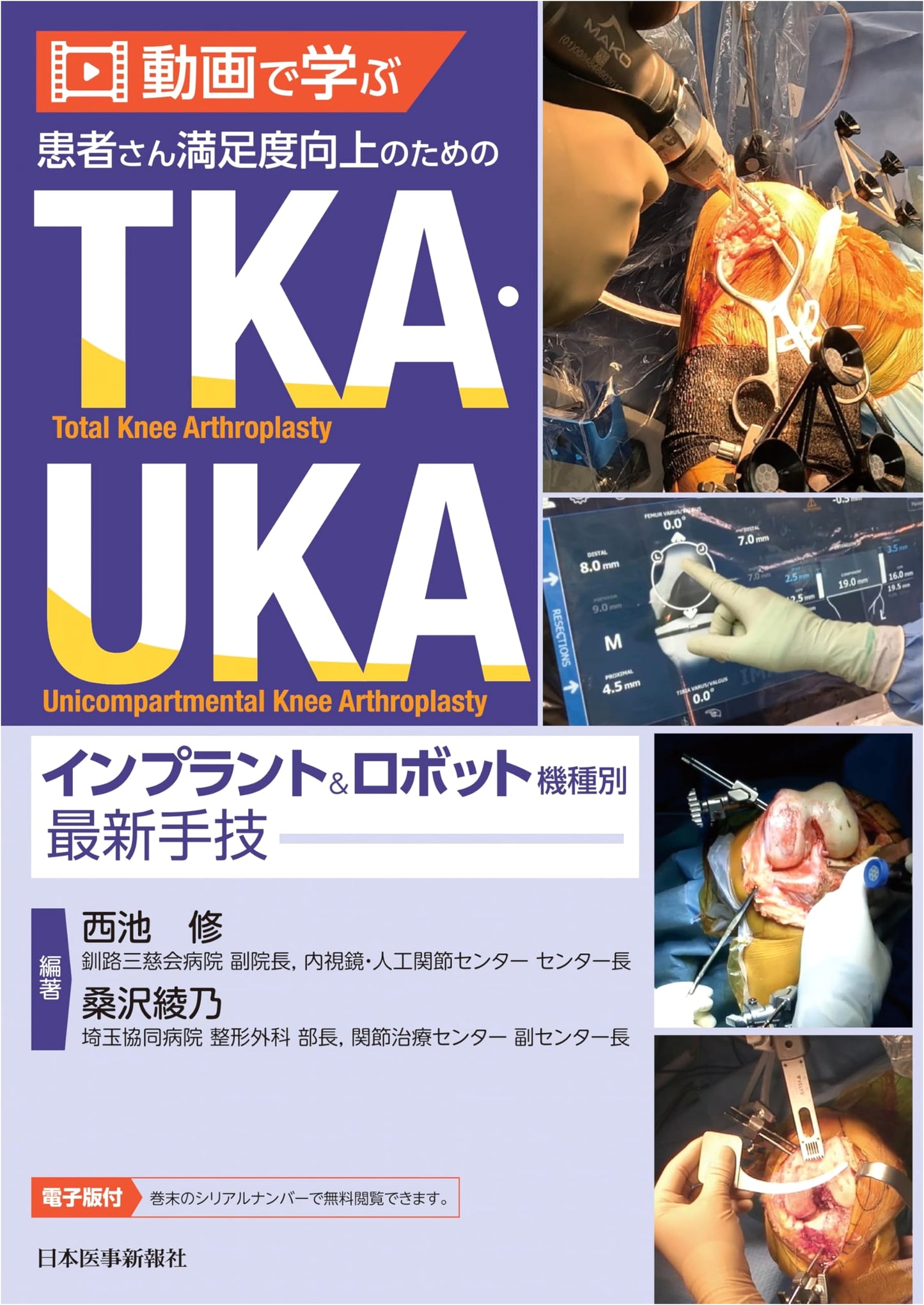Video Learning: Latest TKA & UKA Techniques for Patient Satisfaction (Implants & Robots)