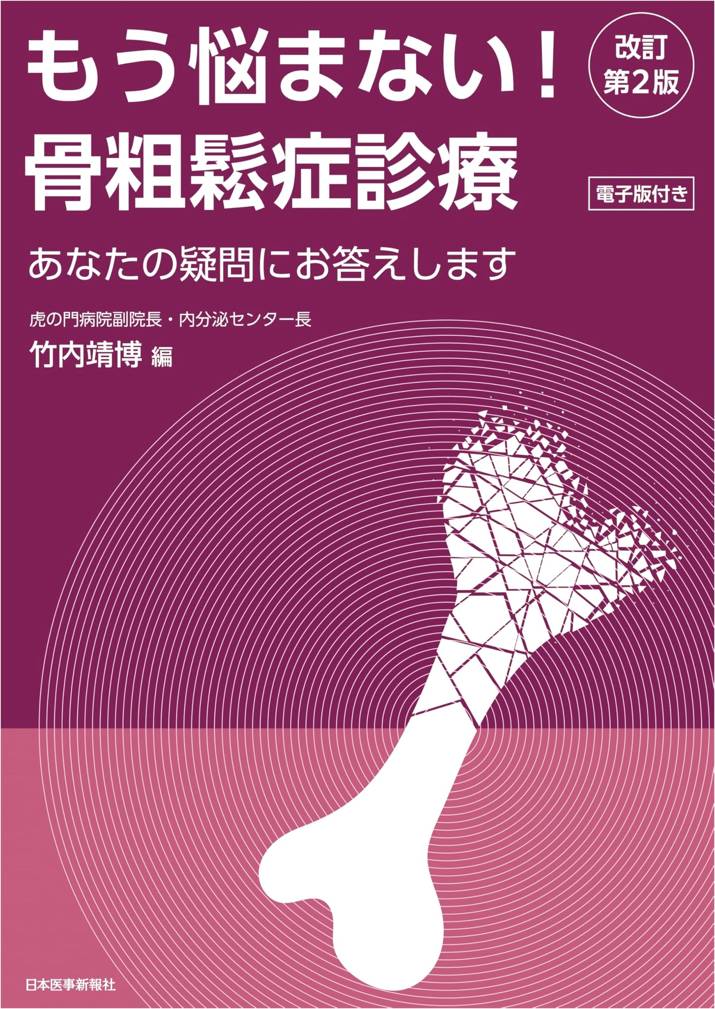 No More Worries! Osteoporosis Diagnosis and Treatment, Revised 2nd Edition
