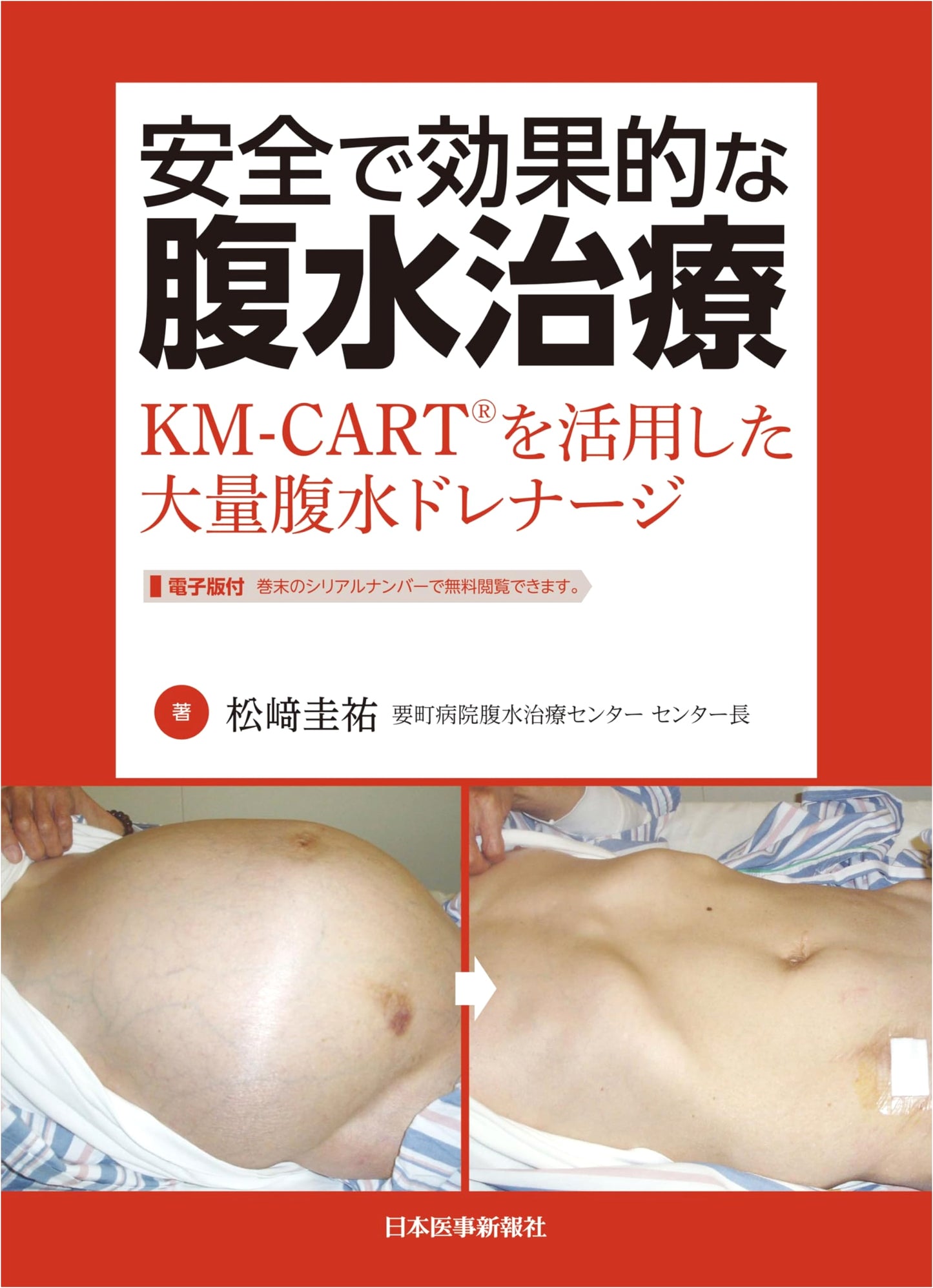 Safe & Effective Ascites Treatment: Large Volume Drainage Utilizing KM-CART