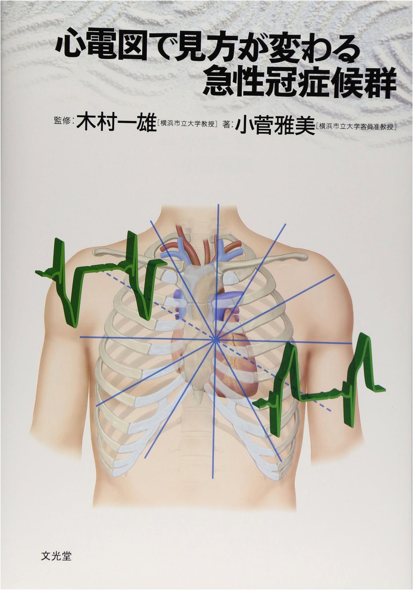 Acute Coronary Syndrome: ECG Interpretation for a Changing Perspective