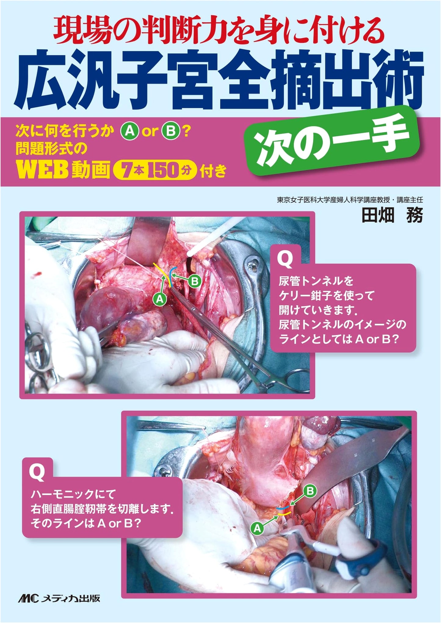 Radical Hysterectomy: Mastering On-the-Spot Decision Making by Tsutomu Tabata