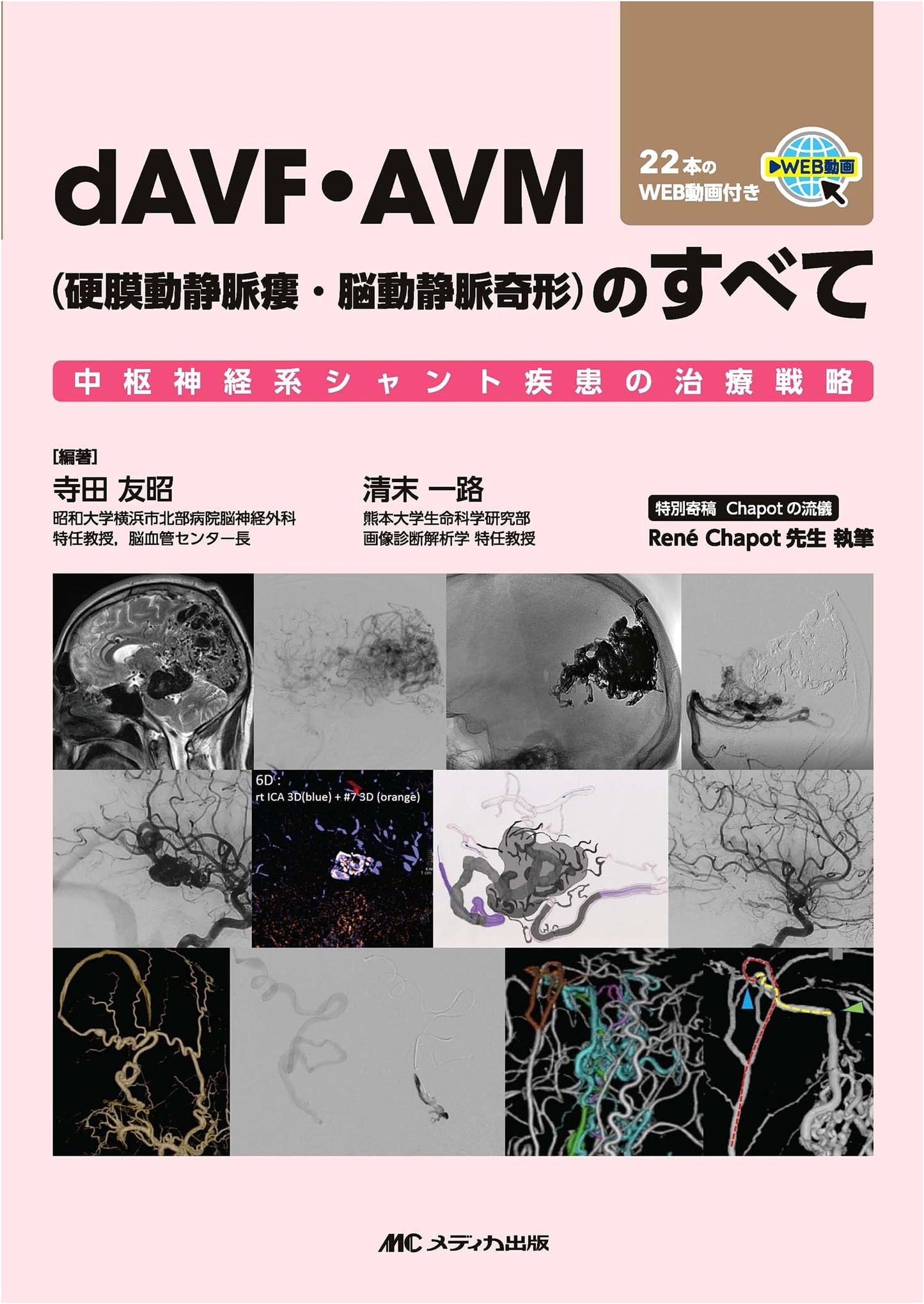 All About dAVF・AVM (Dural Arteriovenous Fistula・Arteriovenous Malformation): Treatment Strategies for CNS Shunt Diseases with 22 Web Videos