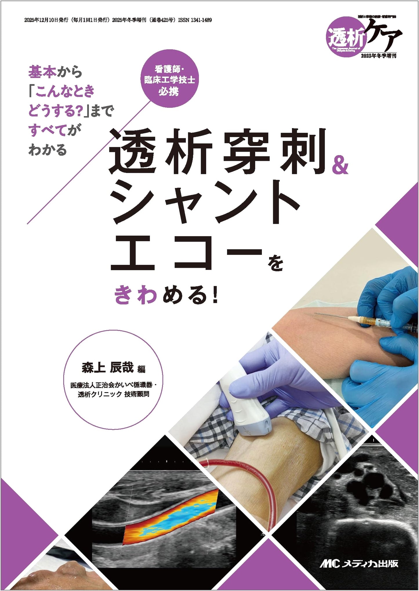 Mastering Dialysis Puncture & Shunt Echo: From Basics to 'What If?' Scenarios